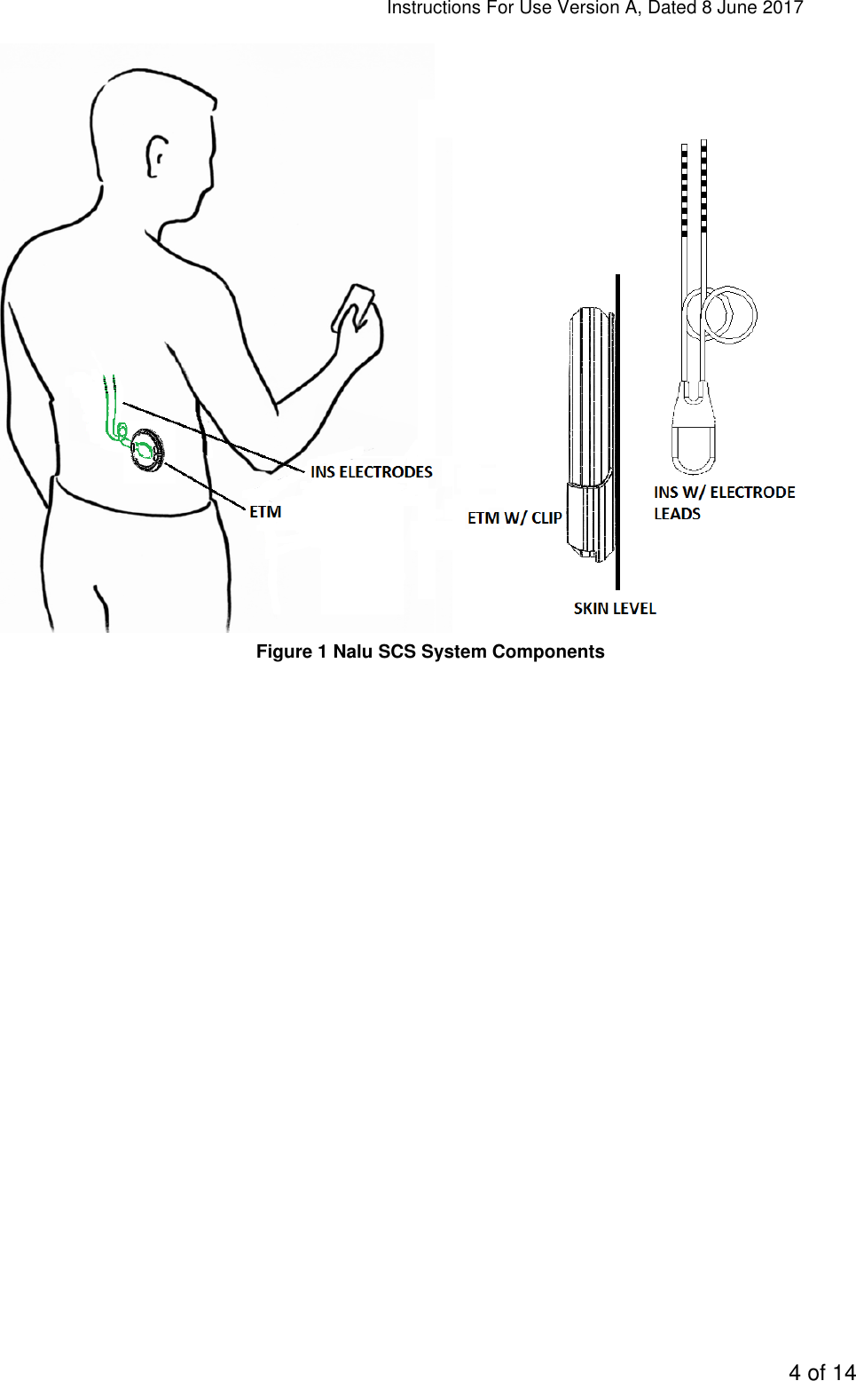 Instructions For Use Version A, Dated 8 June 2017  4 of 14    Figure 1 Nalu SCS System Components 