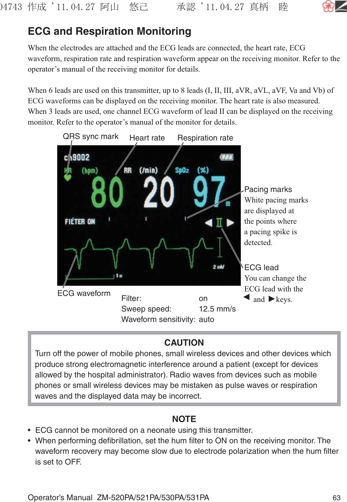 Operator’s Manual  ZM-520PA/521PA/530PA/531PA 63ECG and Respiration MonitoringWhen the electrodes are attached and the ECG leads are connected, the heart rate, ECG waveform, respiration rate and respiration waveform appear on the receiving monitor. Refer to the operator’s manual of the receiving monitor for details.When 6 leads are used on this transmitter, up to 8 leads (I, II, III, aVR, aVL, aVF, Va and Vb) of ECG waveforms can be displayed on the receiving monitor. The heart rate is also measured.When 3 leads are used, one channel ECG waveform of lead II can be displayed on the receiving monitor. Refer to the operator’s manual of the monitor for details.Pacing marksWhite pacing marks are displayed at the points where a pacing spike is detected.Heart rateQRS sync mark Respiration rateECG leadYou can change the ECG lead with the ▼ and ▼ keys.ECG waveform Filter: onSweep speed:  12.5 mm/sWaveform sensitivity:  autoCAUTIONTurn off the power of mobile phones, small wireless devices and other devices which produce strong electromagnetic interference around a patient (except for devices allowed by the hospital administrator). Radio waves from devices such as mobile phones or small wireless devices may be mistaken as pulse waves or respiration waves and the displayed data may be incorrect.NOTE•  ECG cannot be monitored on a neonate using this transmitter.•  When performing deﬁbrillation, set the hum ﬁlter to ON on the receiving monitor. The waveform recovery may become slow due to electrode polarization when the hum ﬁlter is set to OFF.૞ᚑ㒙ጊޓᖘᏆ ᛚ⹺⌀ᨩޓ⌬