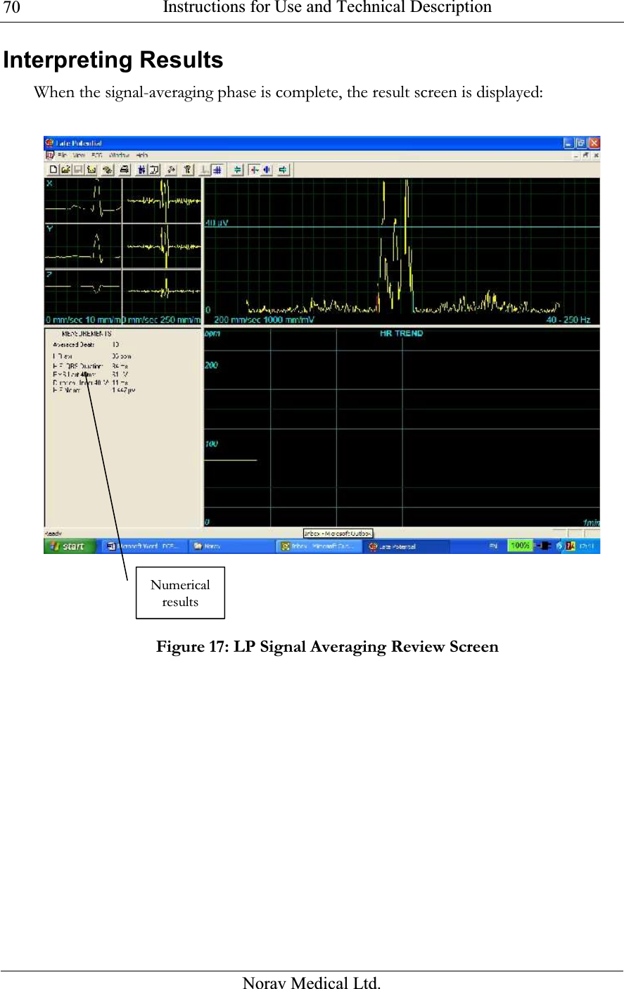  Instructions for Use and Technical Description  Norav Medical Ltd. 70Interpreting Results When the signal-averaging phase is complete, the result screen is displayed:   Figure 17: LP Signal Averaging Review Screen Numerical results 