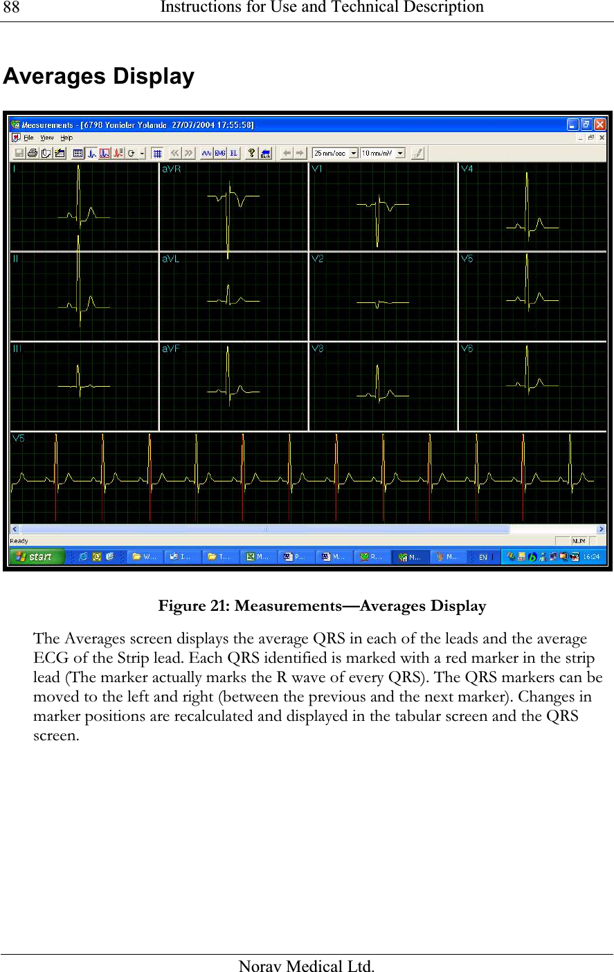  Instructions for Use and Technical Description  Norav Medical Ltd. 88Averages Display    Figure 21: Measurements—Averages Display The Averages screen displays the average QRS in each of the leads and the average ECG of the Strip lead. Each QRS identified is marked with a red marker in the strip lead (The marker actually marks the R wave of every QRS). The QRS markers can be moved to the left and right (between the previous and the next marker). Changes in marker positions are recalculated and displayed in the tabular screen and the QRS screen. 