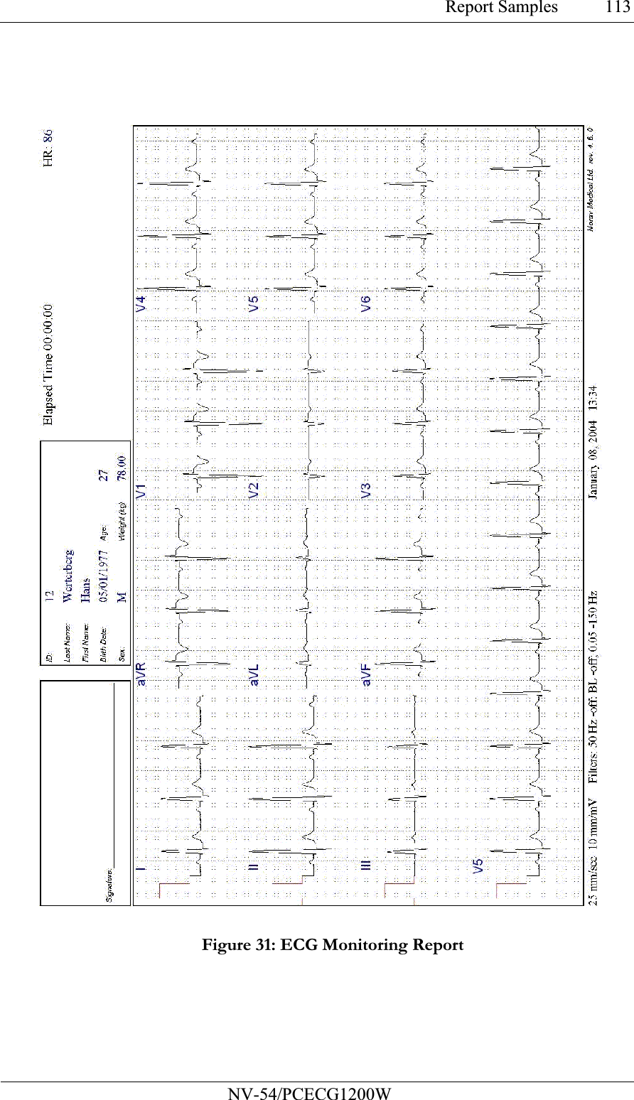 Report Samples           NV-54/PCECG1200W 113 Figure 31: ECG Monitoring Report  