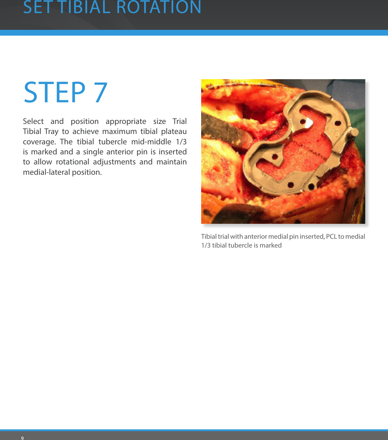 9SET TIBIAL ROTATIONSTEP 7Select and position appropriate size Trial Tibial Tray to achieve maximum tibial plateau coverage. The tibial tubercle mid-middle 1/3 is marked and a single anterior pin is inserted to allow rotational adjustments and maintain medial-lateral position.Tibial trial with anterior medial pin inserted, PCL to medial 1/3 tibial tubercle is marked