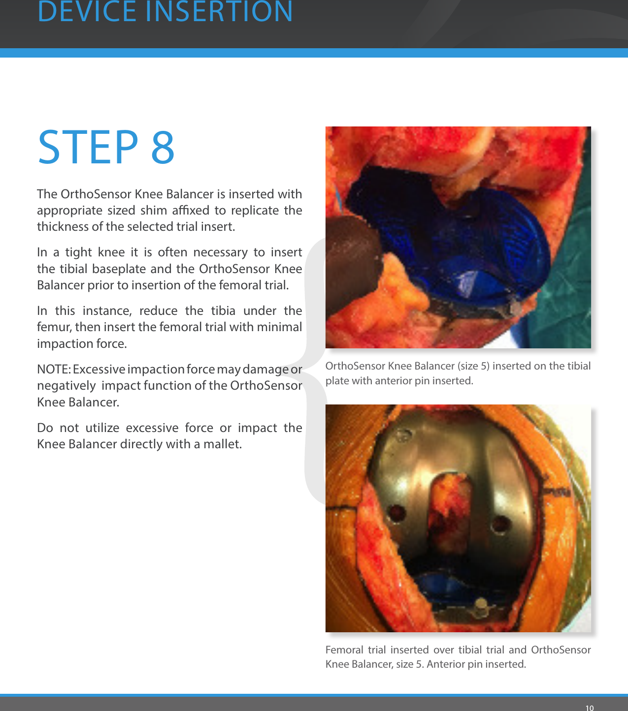 10STEP 8The OrthoSensor Knee Balancer is inserted with appropriate sized shim axed to replicate the thickness of the selected trial insert.In a tight knee it is often necessary to insert the tibial baseplate and the OrthoSensor Knee Balancer prior to insertion of the femoral trial.In this instance, reduce the tibia under the femur, then insert the femoral trial with minimal impaction force.NOTE: Excessive impaction force may damage or negatively  impact function of the OrthoSensor Knee Balancer. Do not utilize excessive force or impact the Knee Balancer directly with a mallet. OrthoSensor Knee Balancer (size 5) inserted on the tibial plate with anterior pin inserted.Femoral trial inserted over tibial trial and OrthoSensor Knee Balancer, size 5. Anterior pin inserted.DEVICE INSERTION