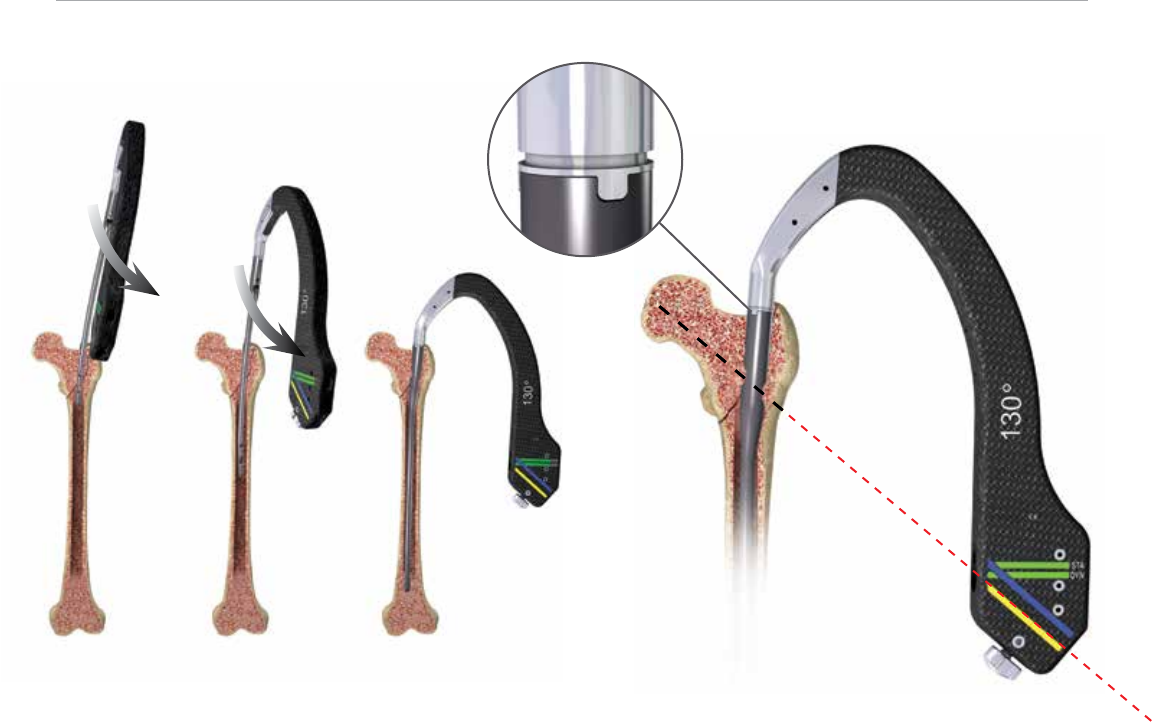 Affixus Hip Fracture Nail Surgical Technique