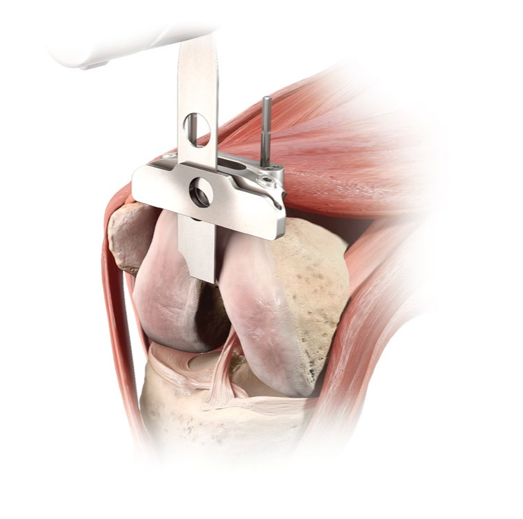 Attune Surgical Technique Intuition Instruments