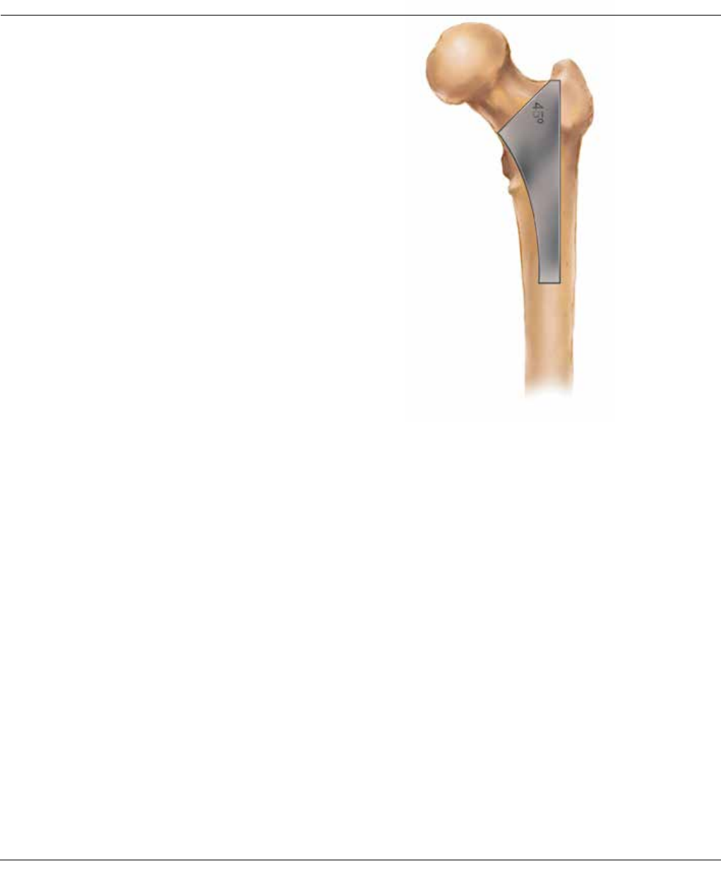 Corail Surgical Technique 1