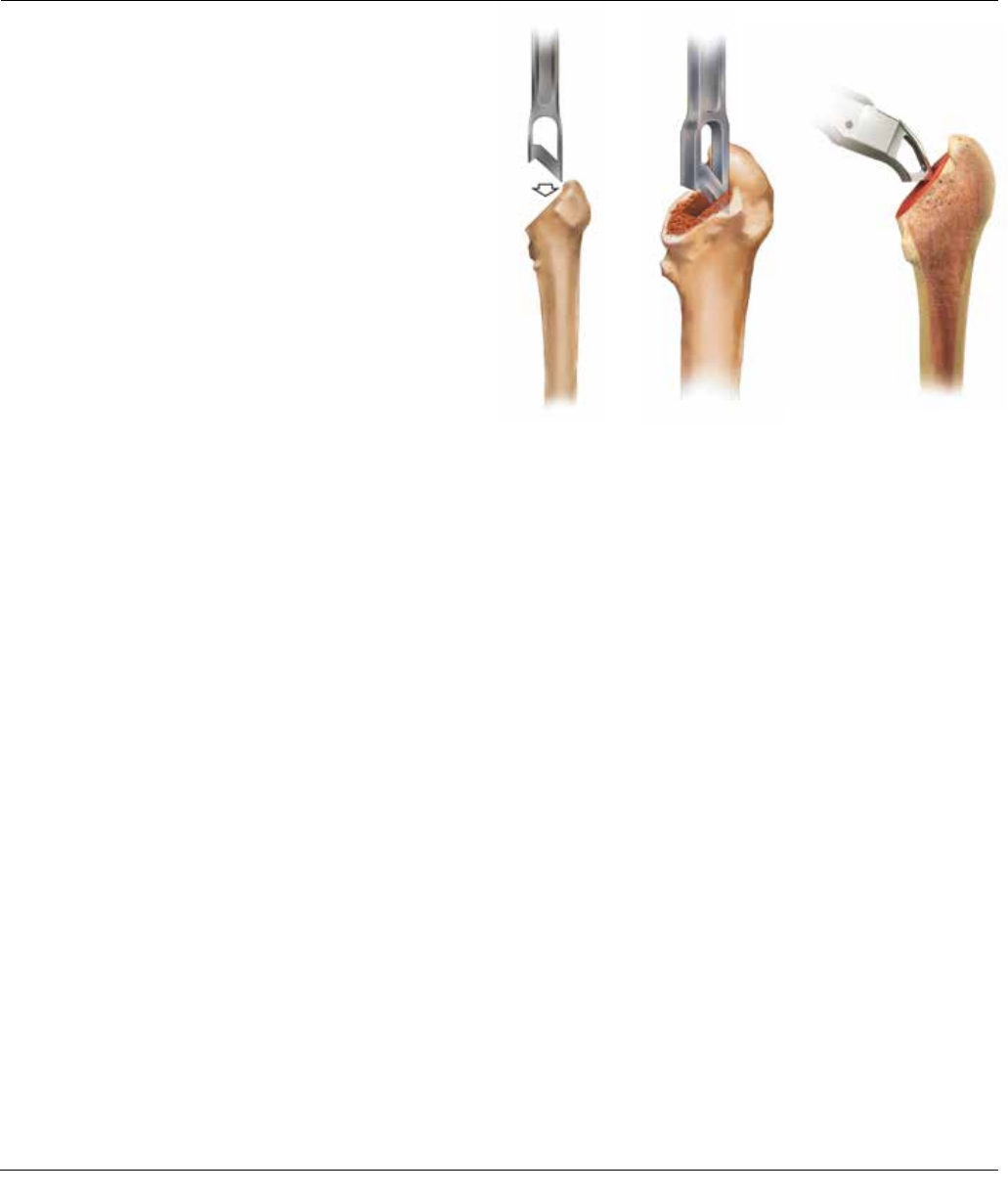 Corail Surgical Technique 1