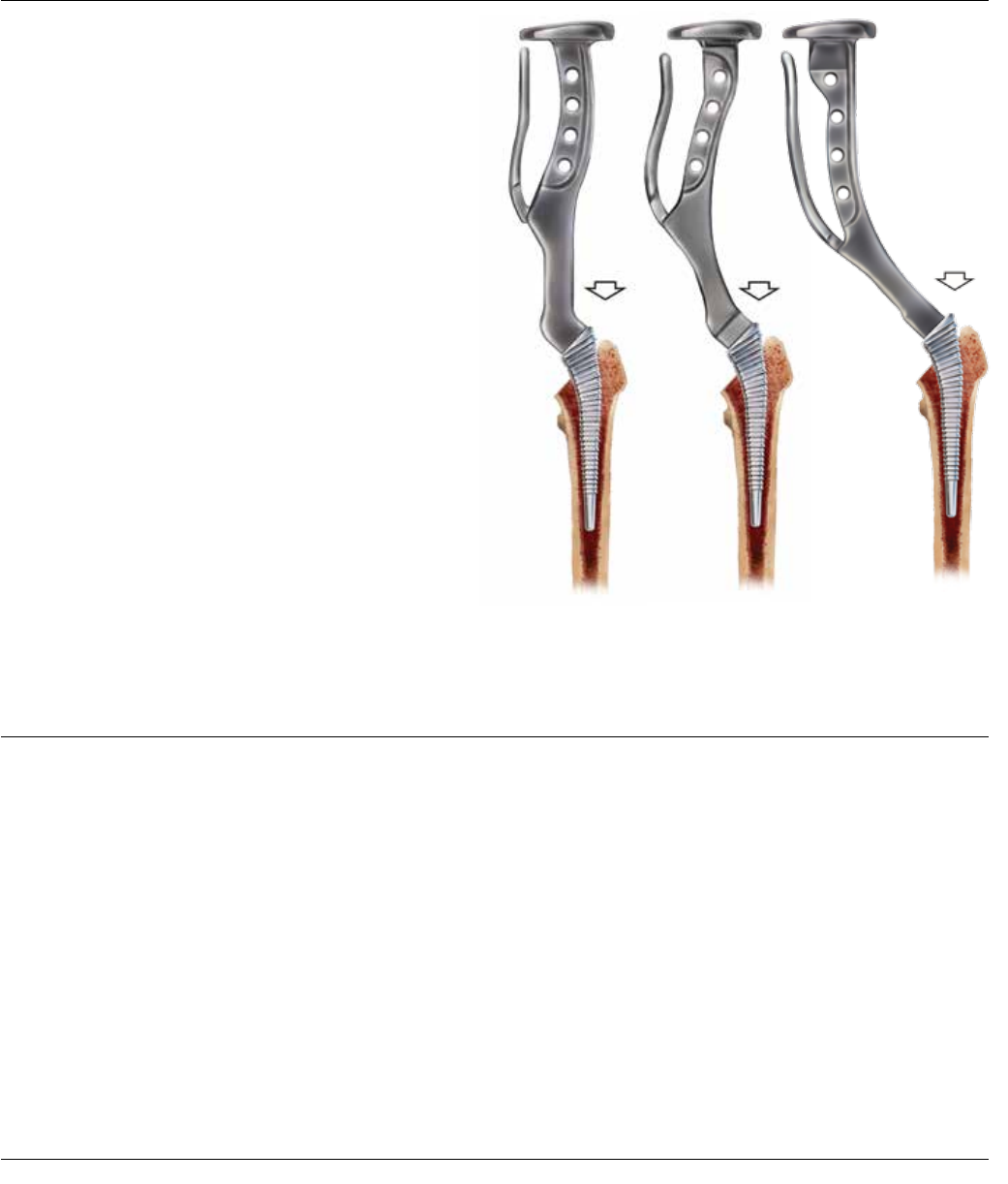 Corail Surgical Technique 1