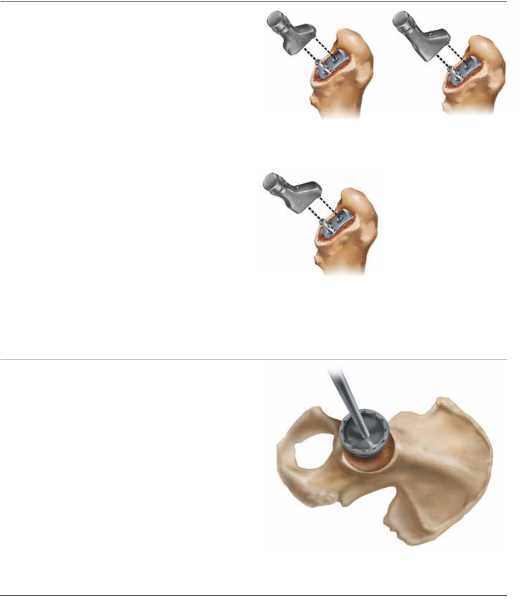 Corail Surgical Technique 1