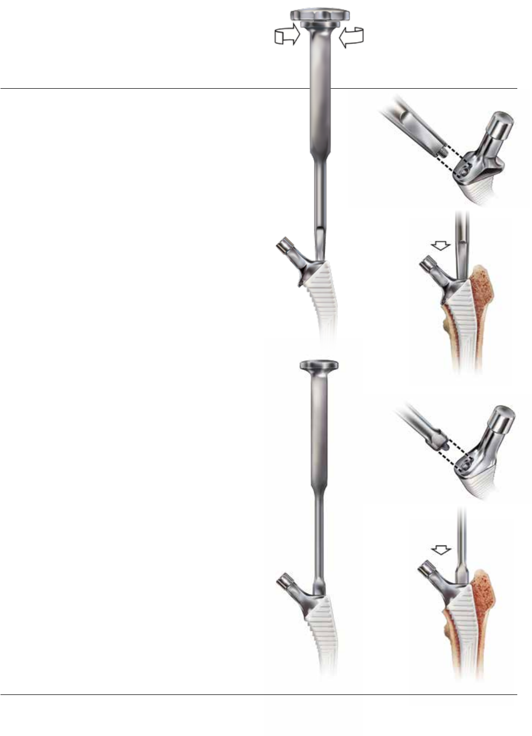 Corail Surgical Technique 1