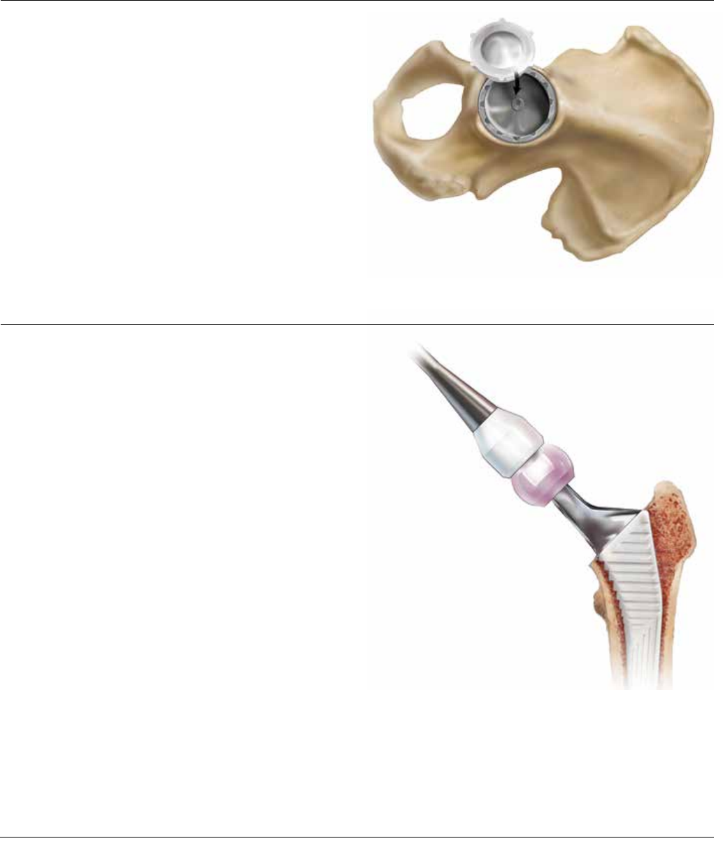 Corail Surgical Technique 1