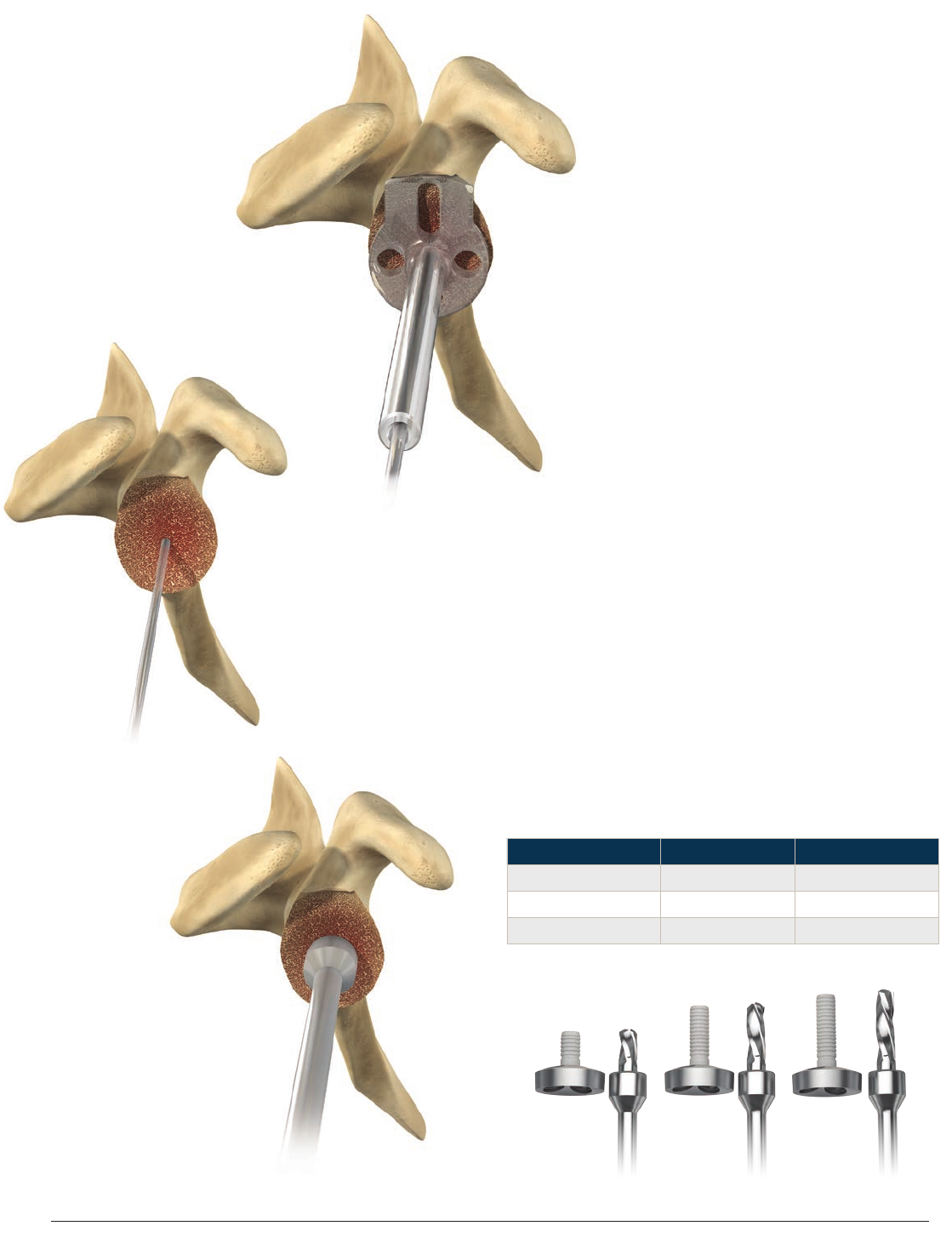 Delta Xtend Reverse Shoulder System Surgical Technique