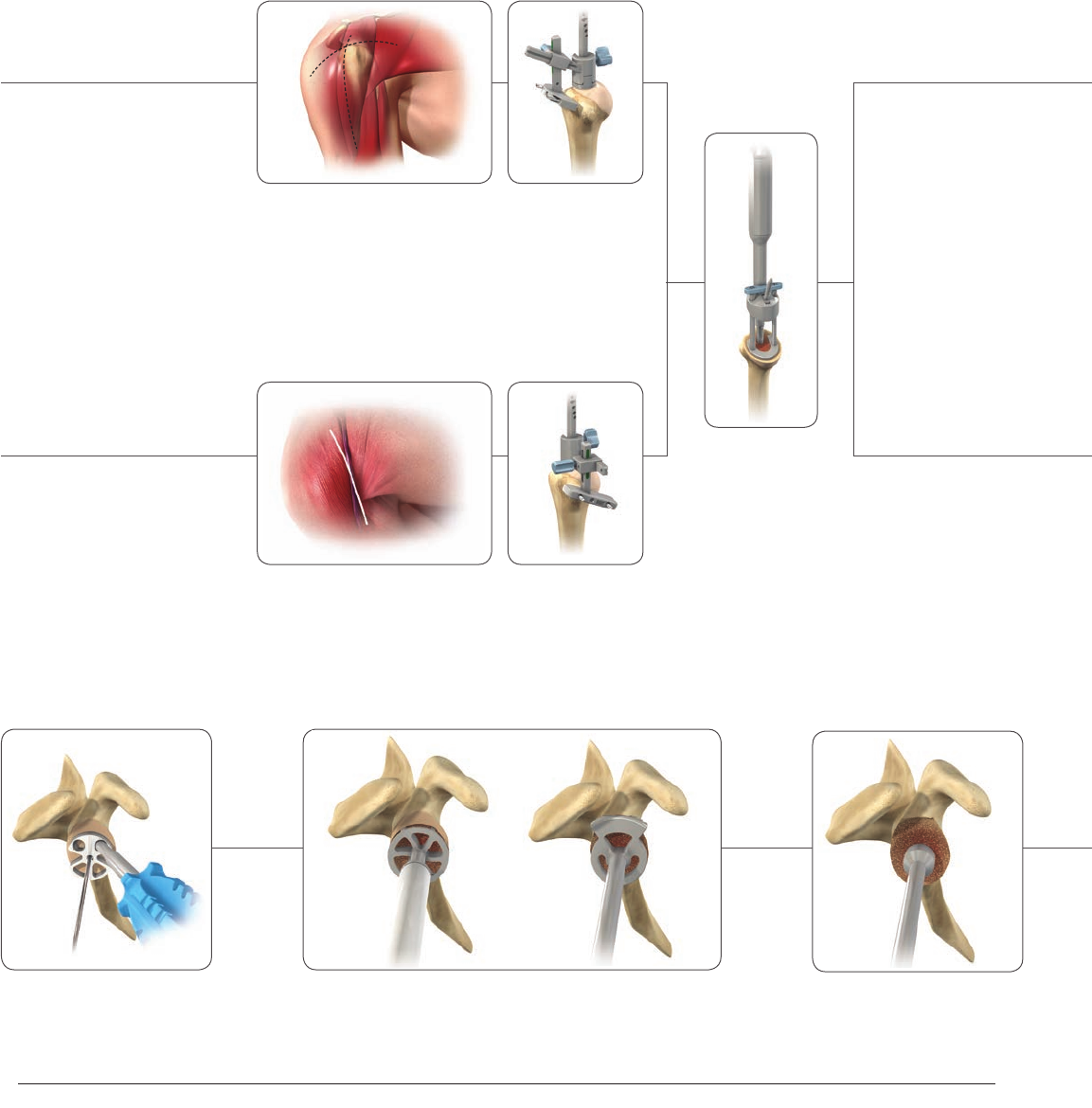 Delta Xtend Reverse Shoulder System Surgical Technique