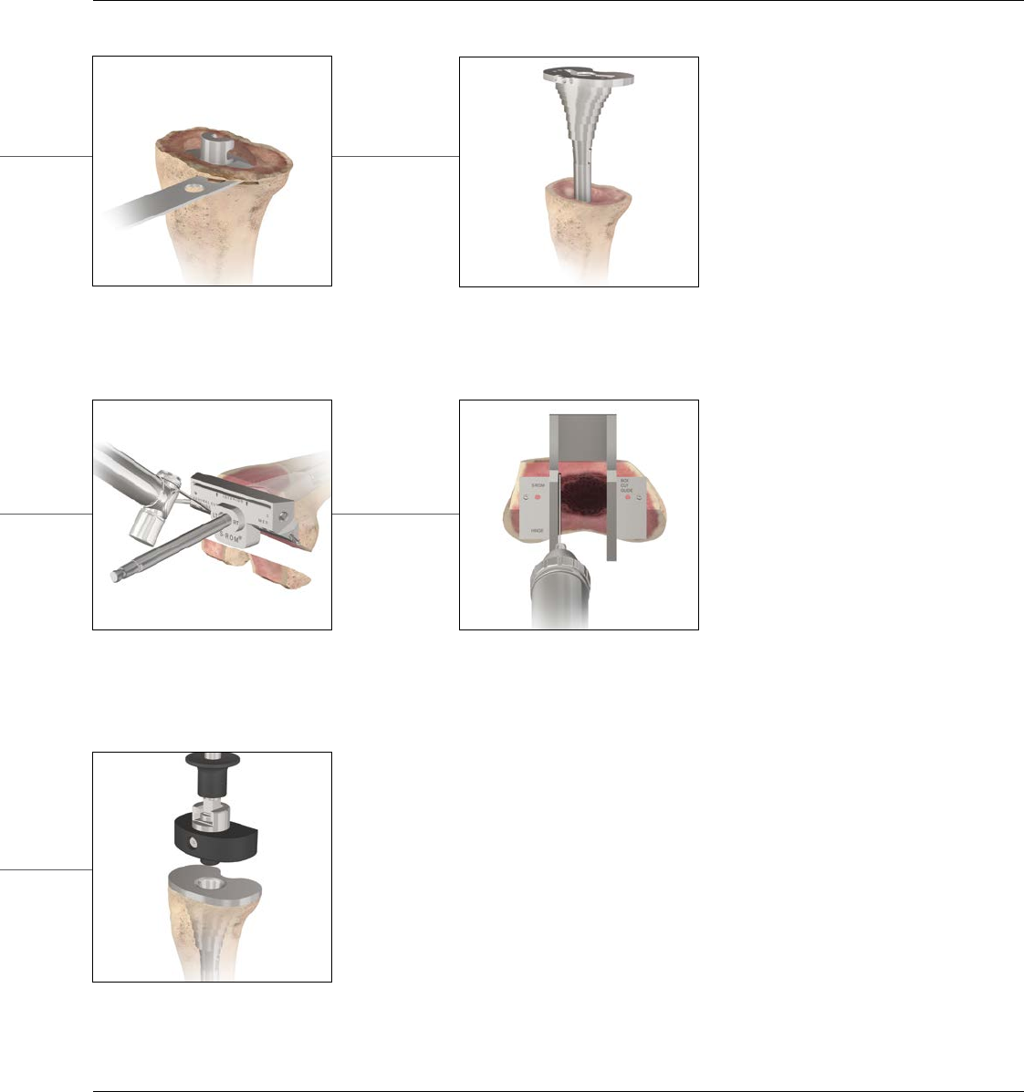 DPY S ROM Noiles Rotating Hinge Surgical Technique 0612 85 510