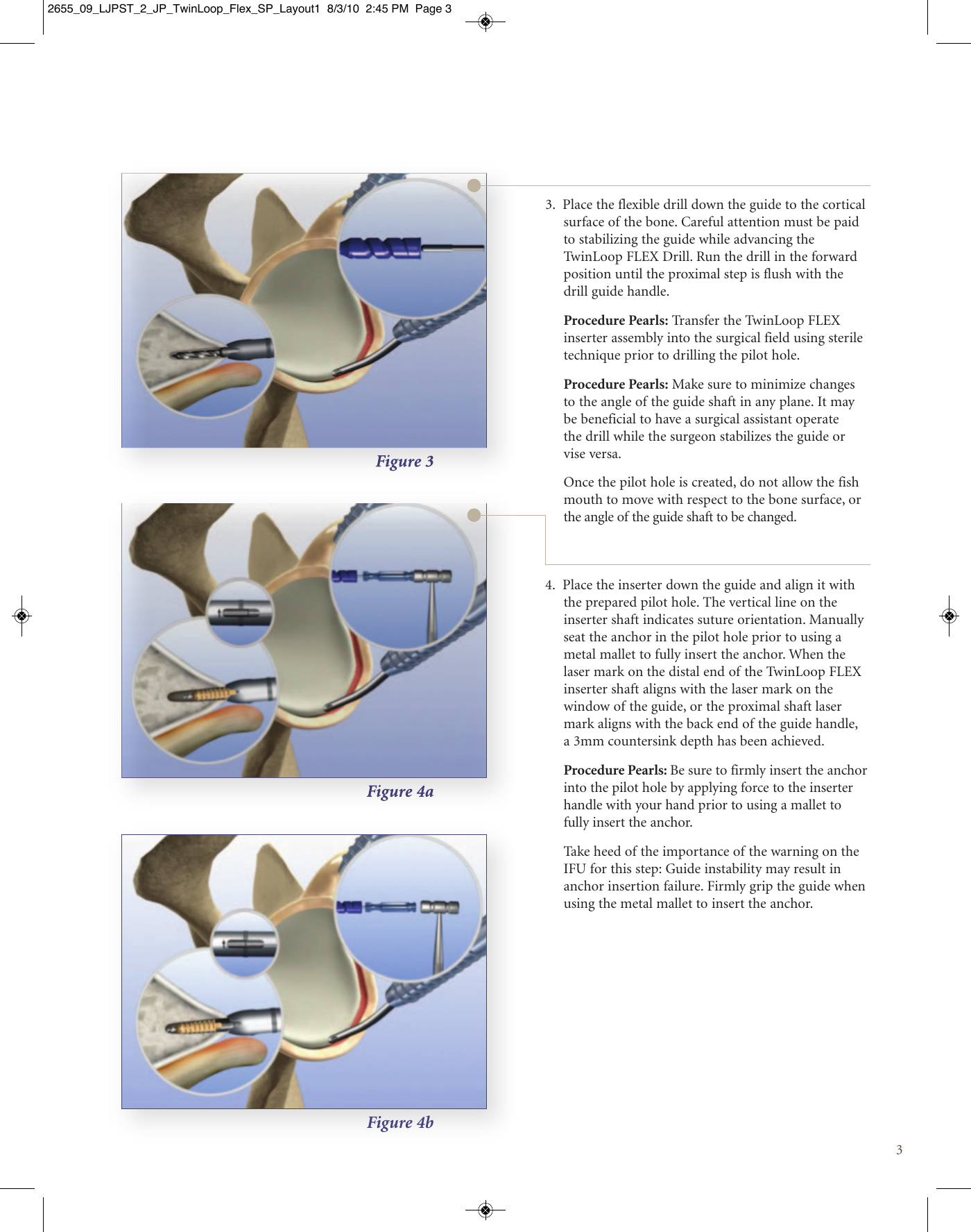 Page 3 of 8 - Stryker Brochure - Plastic Coil  Flex Instability Surgical Technique