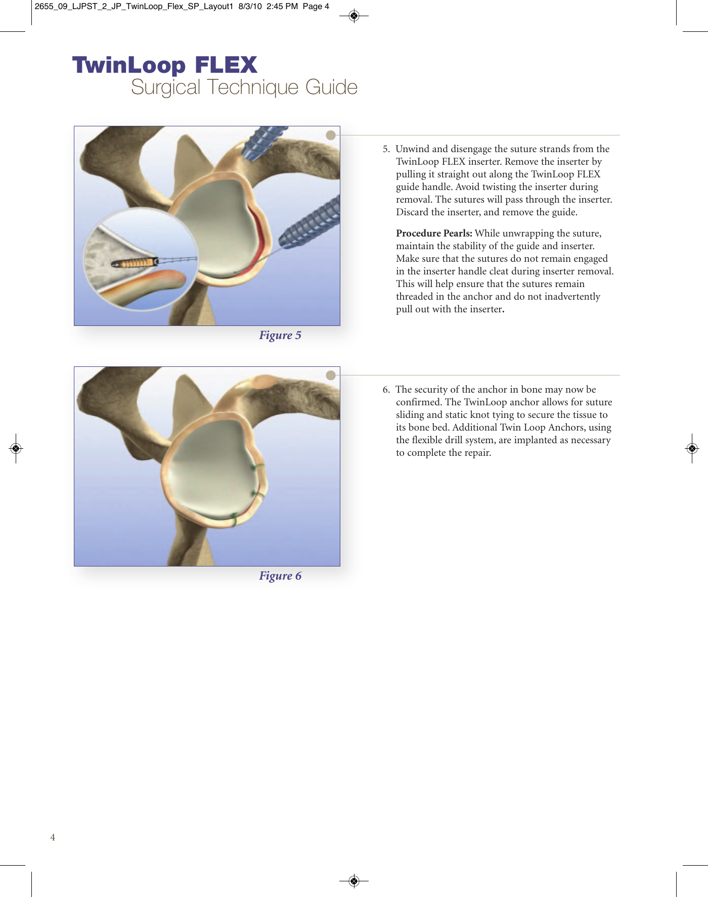 Page 4 of 8 - Stryker Brochure - Plastic Coil  Flex Instability Surgical Technique