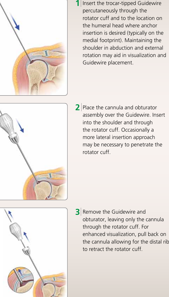 Page 6 of 12 - HEALIX TRANSTEND Implant System Brochure