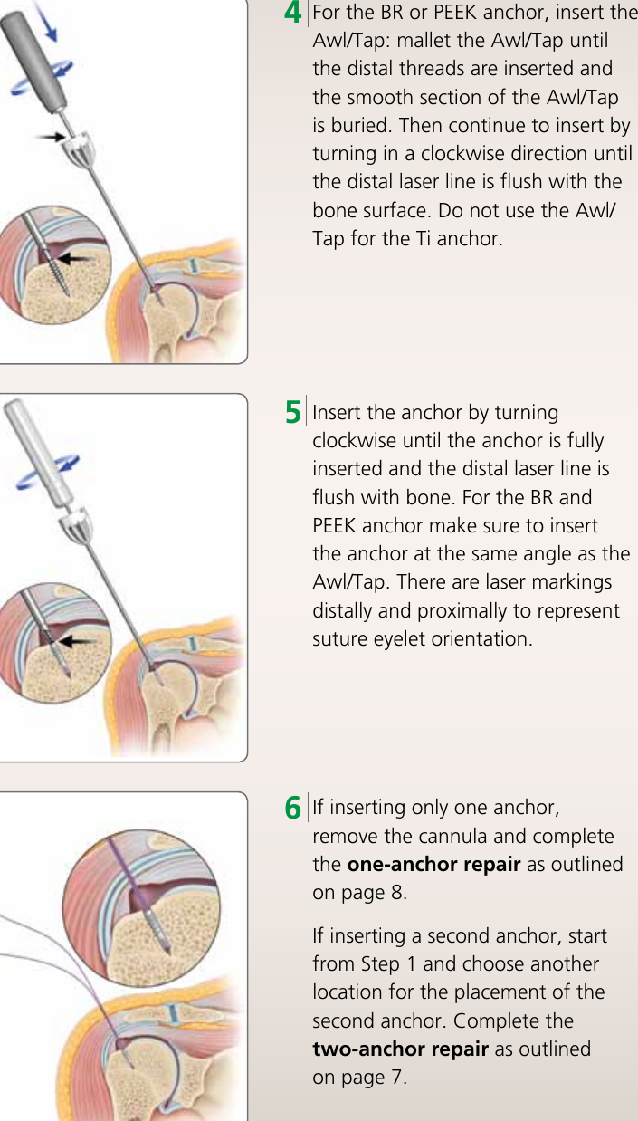 Page 7 of 12 - HEALIX TRANSTEND Implant System Brochure