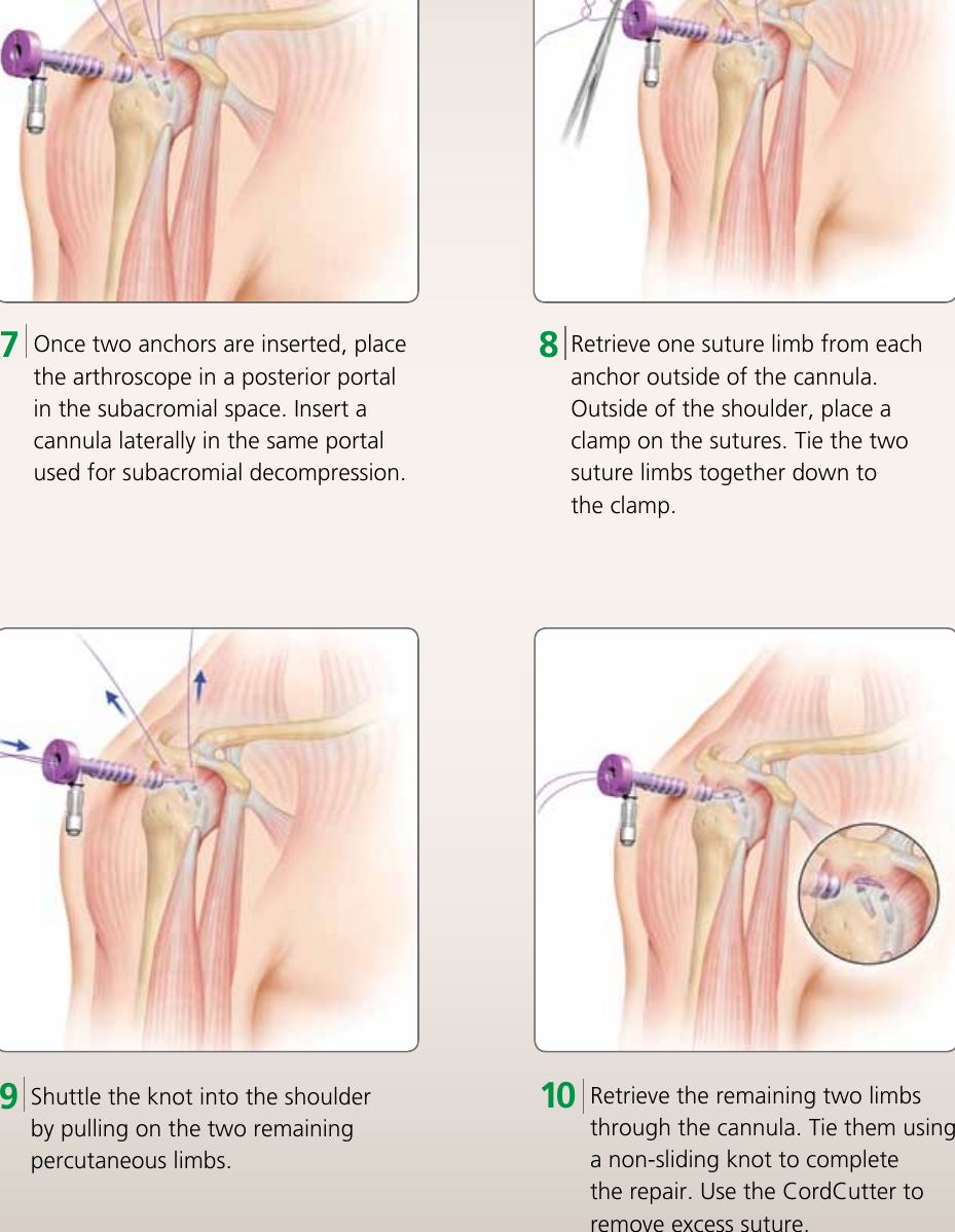 Page 8 of 12 - HEALIX TRANSTEND Implant System Brochure