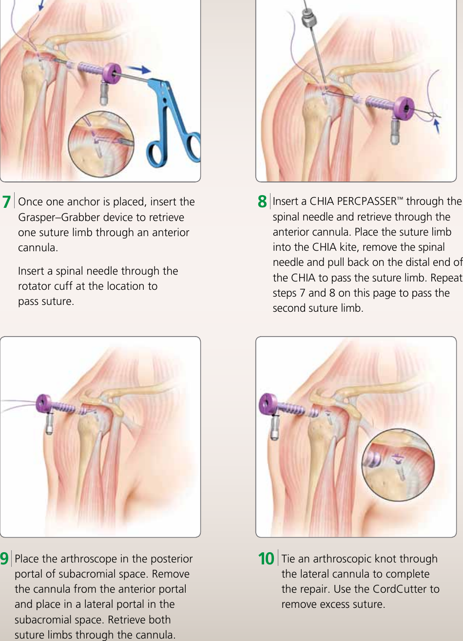 Page 9 of 12 - HEALIX TRANSTEND Implant System Brochure