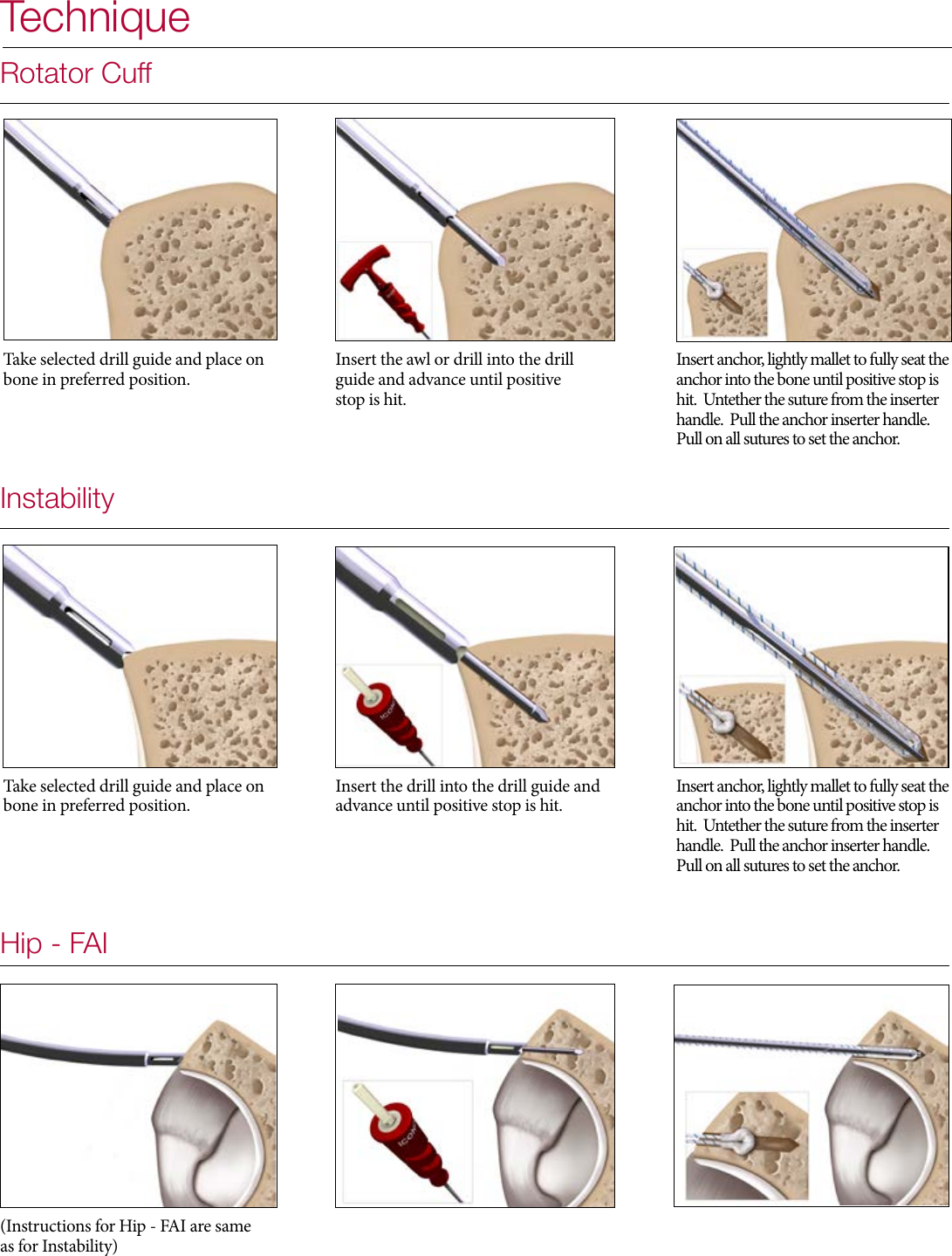 Page 6 of 8 - Iconix All Suture Anchor Brochure