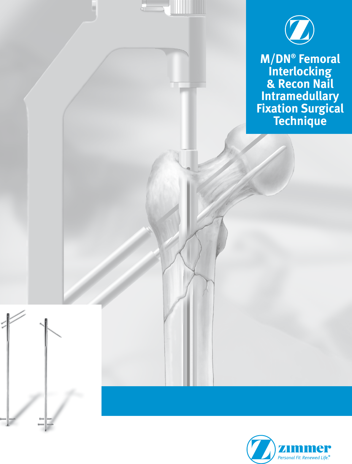M/DN® Femoral Interlocking & Recon Nail Intramedullary Fixation