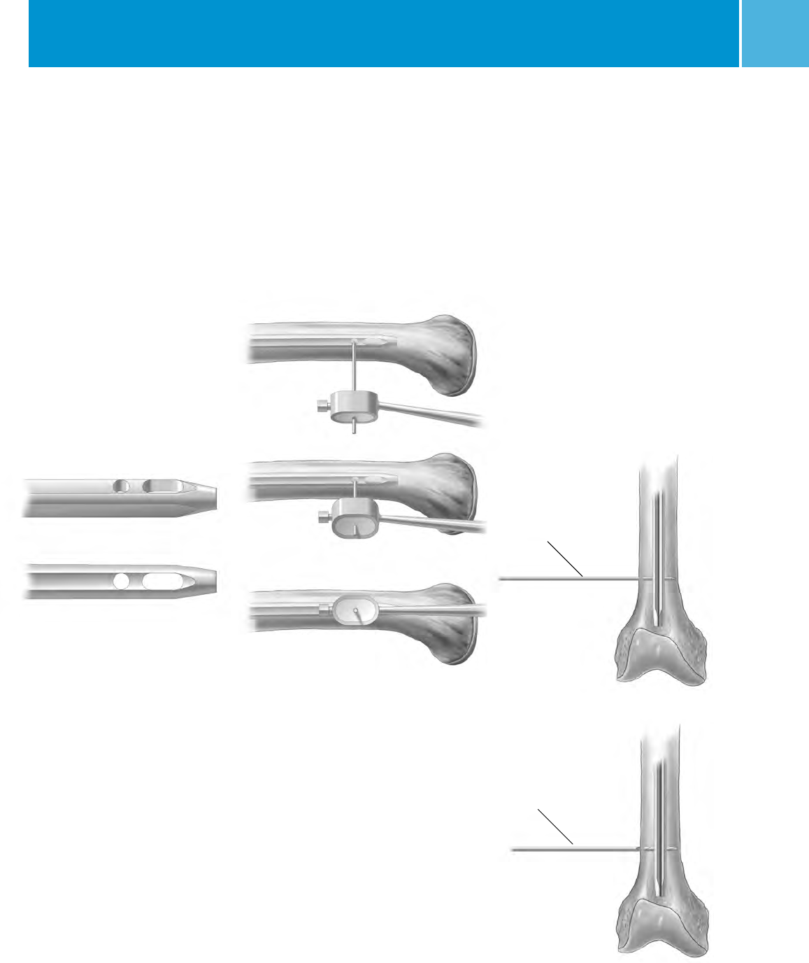 M/DN® Femoral Interlocking & Recon Nail Intramedullary Fixation