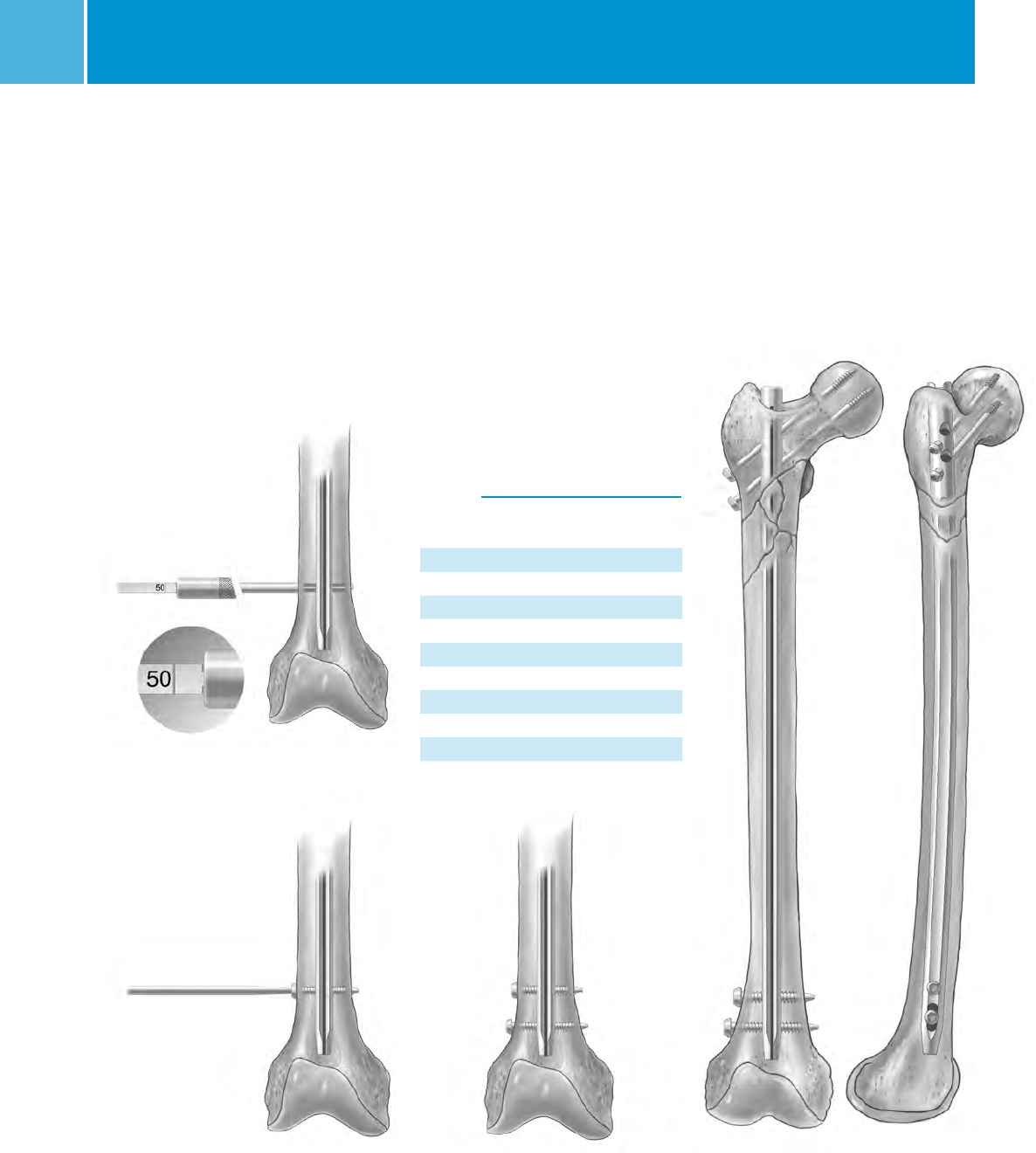 M/DN® Femoral Interlocking & Recon Nail Intramedullary Fixation