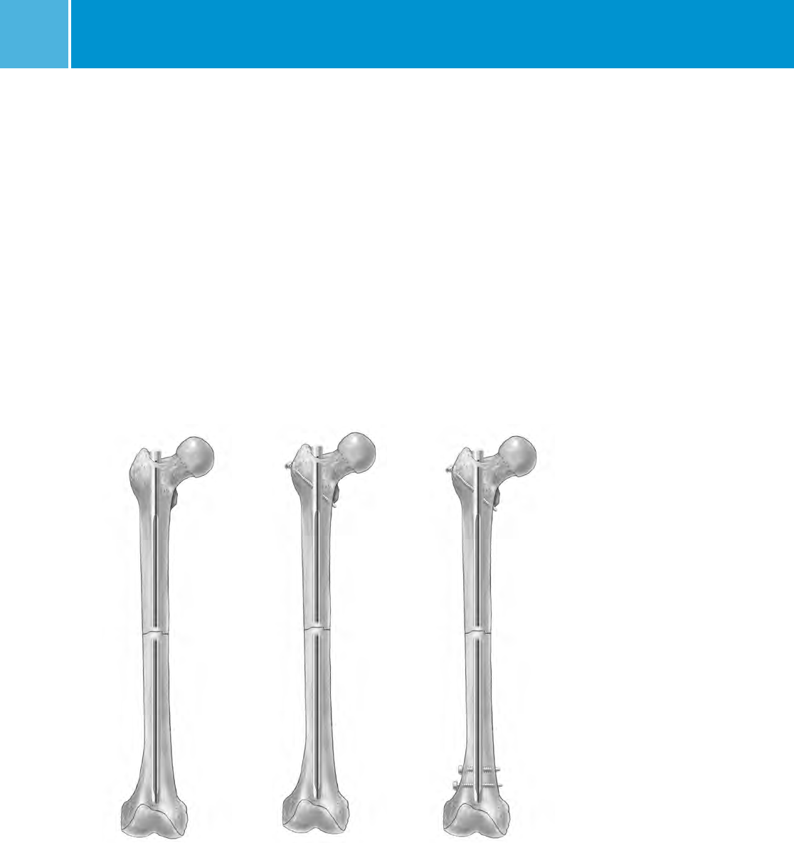 M/DN® Femoral Interlocking & Recon Nail Intramedullary Fixation