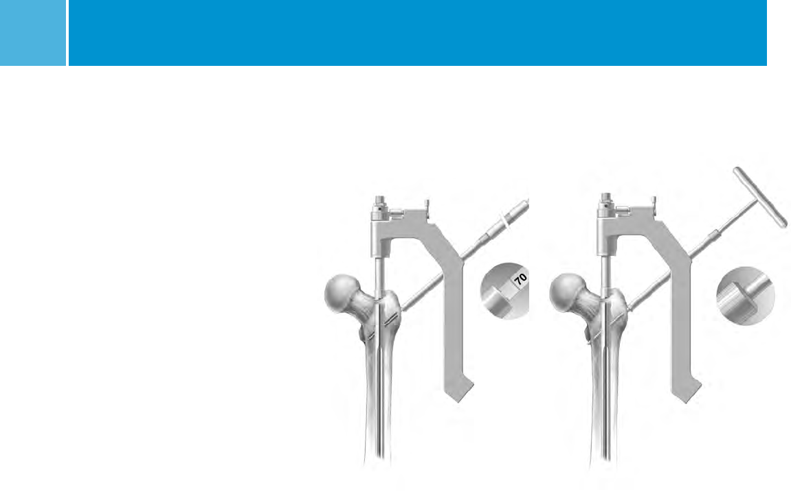 M/DN® Femoral Interlocking & Recon Nail Intramedullary Fixation