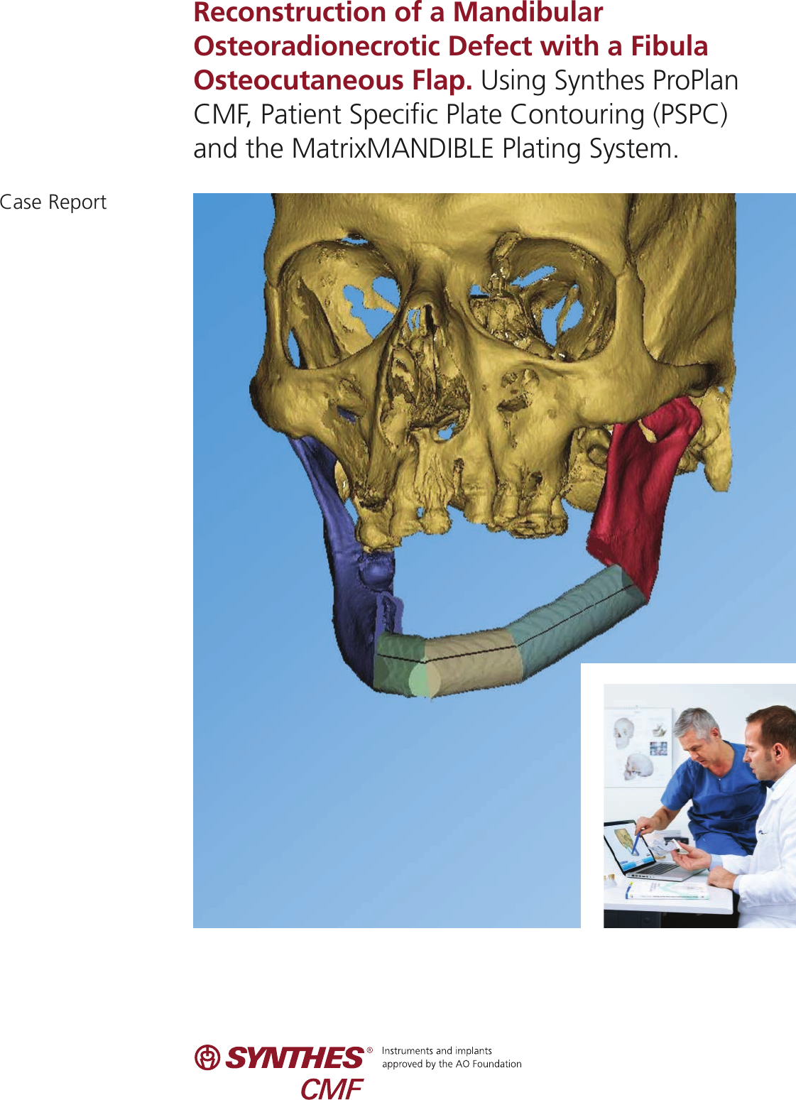 Page 1 of 11 - MXCSRecon Osteo Defect J11837A
