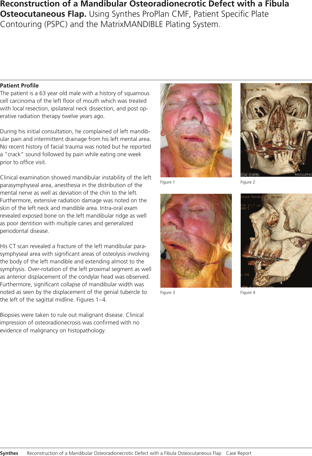 Page 2 of 11 - MXCSRecon Osteo Defect J11837A