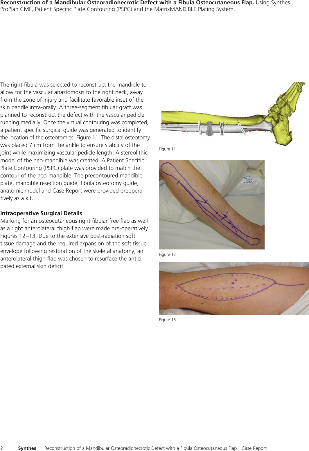 Page 4 of 11 - MXCSRecon Osteo Defect J11837A