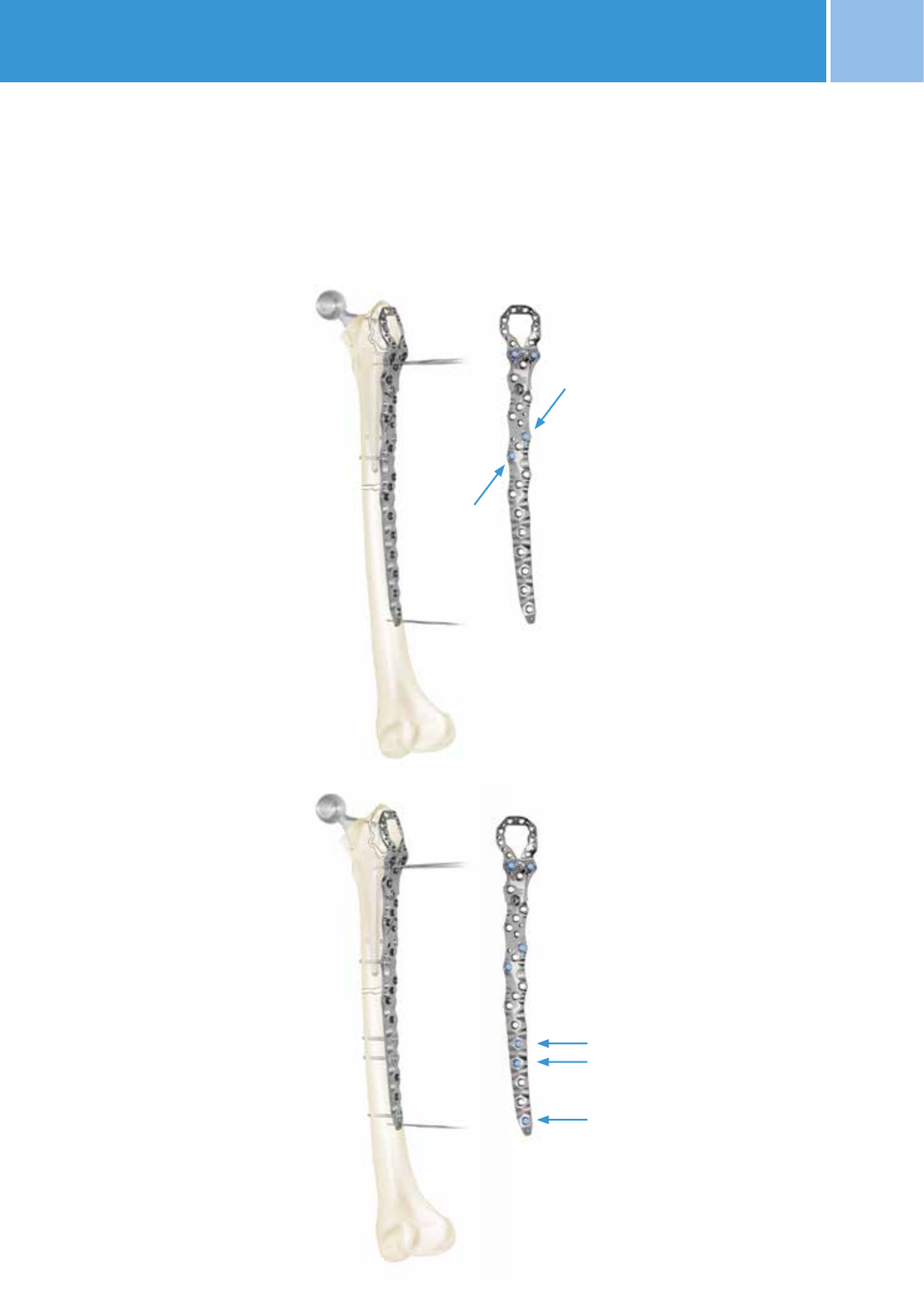 Biomet Distal Femur Plate