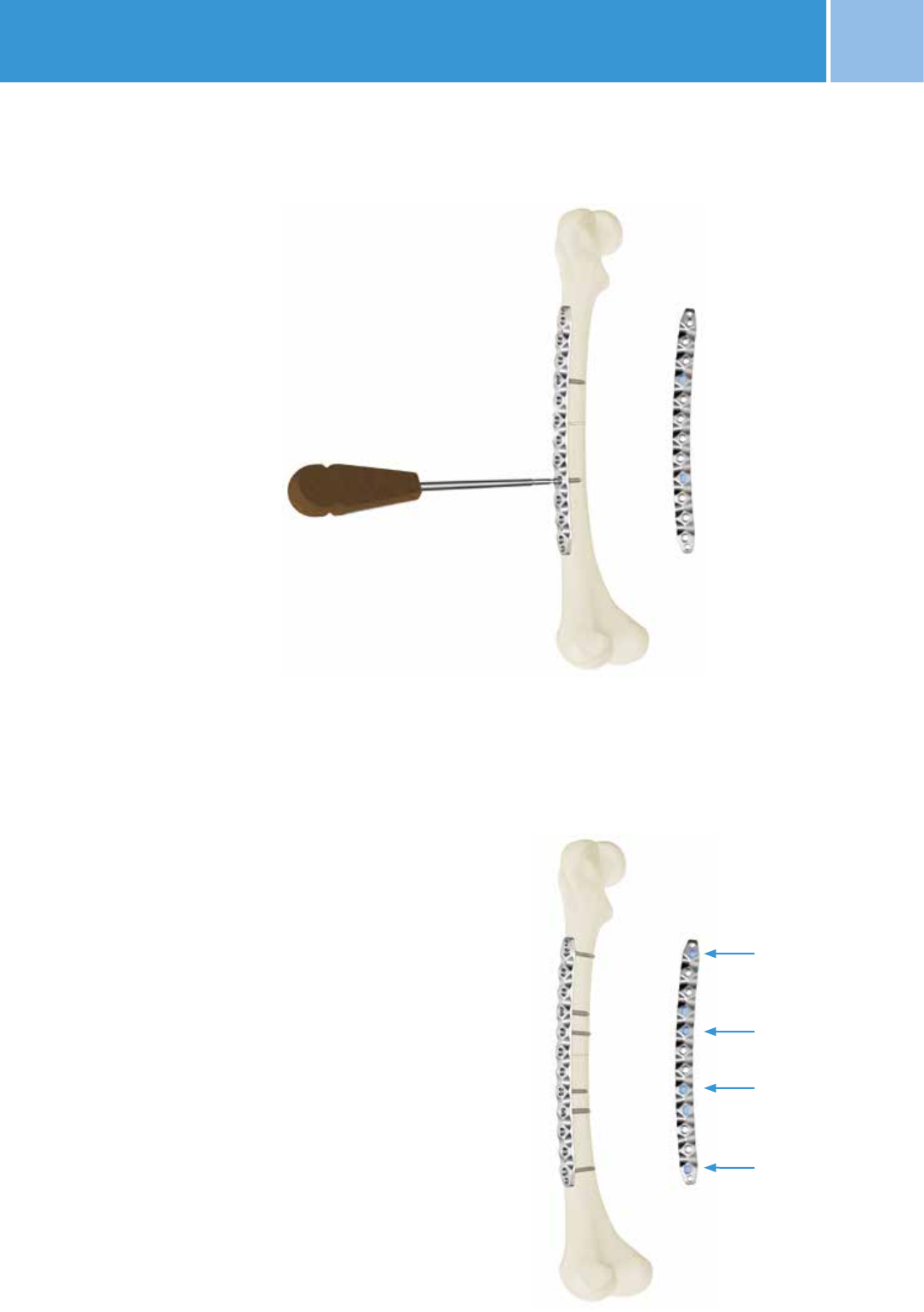 NCB Periprosthetic Femur Plate Surgical Technique