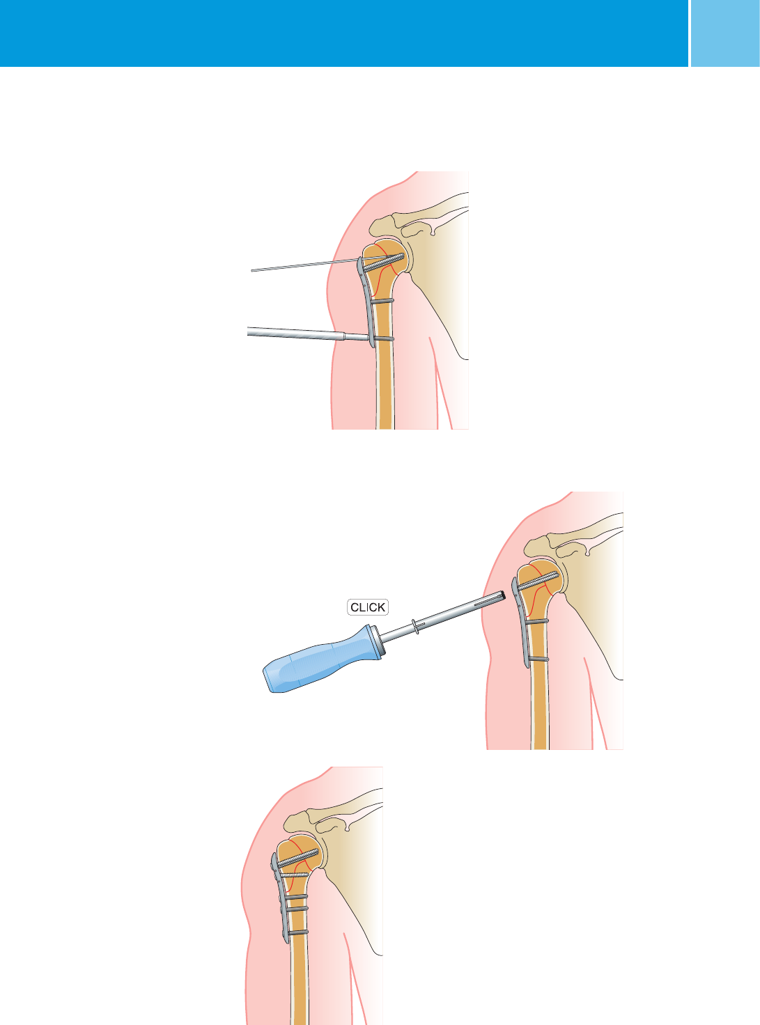 Ncb Proximal Humerus Surgical Technique System