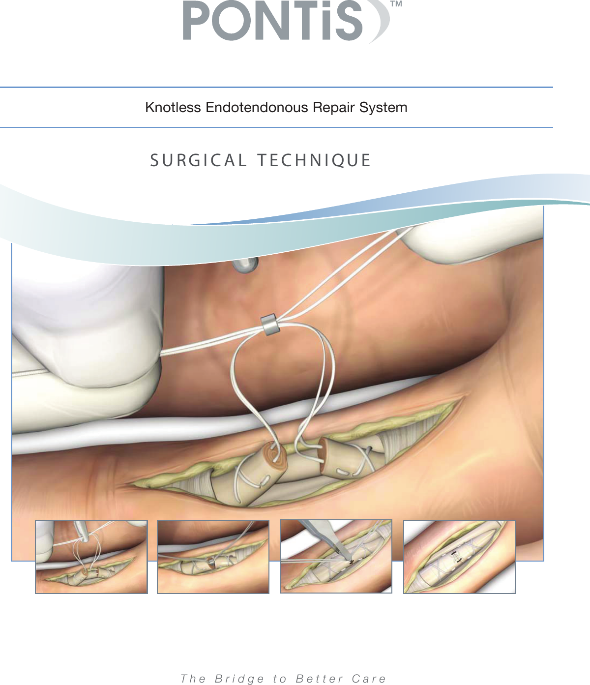 Page 1 of 9 - Print  PONTi S Surgical Technique Brochure 08Oct15