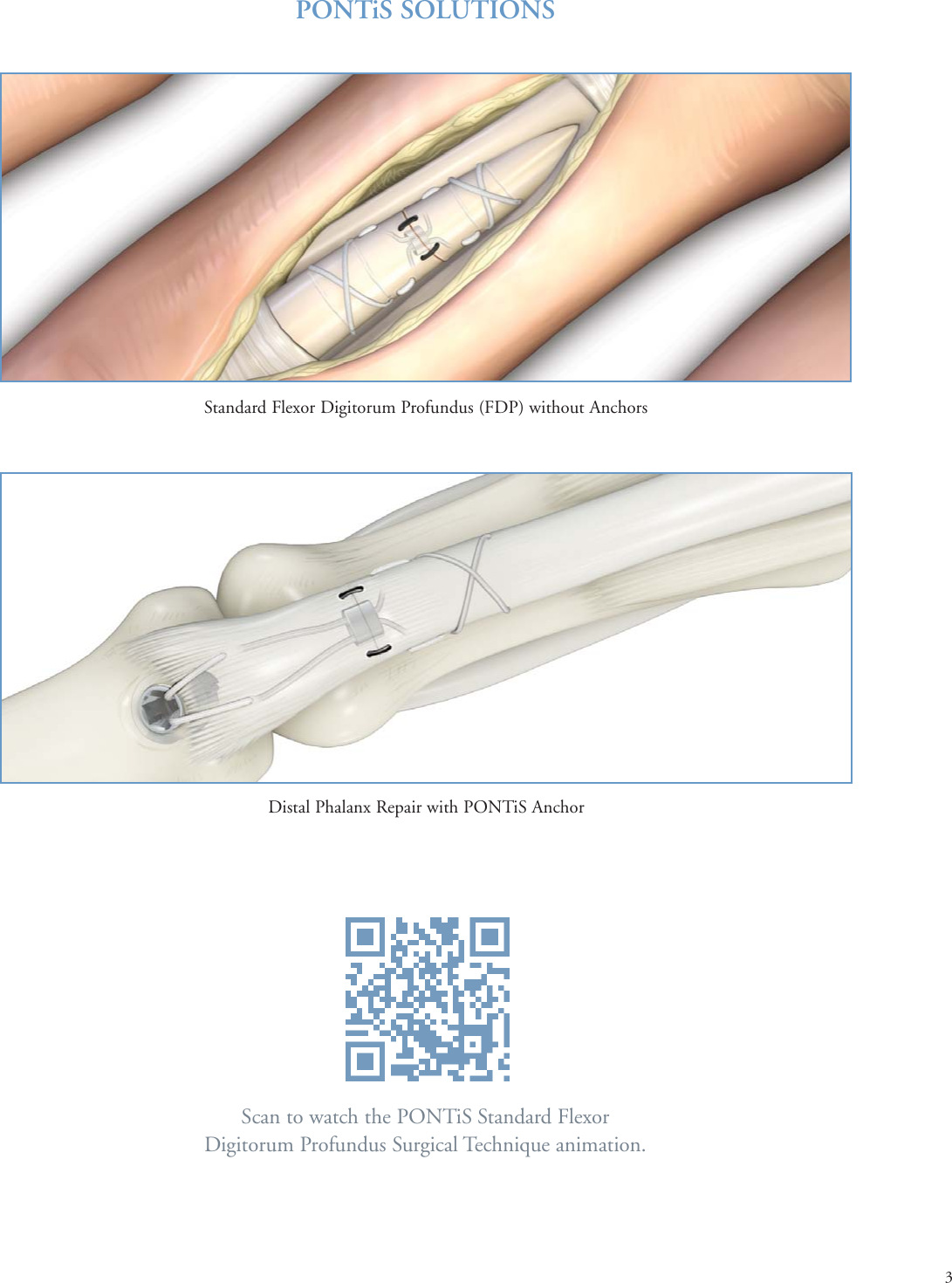 Page 3 of 9 - Print  PONTi S Surgical Technique Brochure 08Oct15