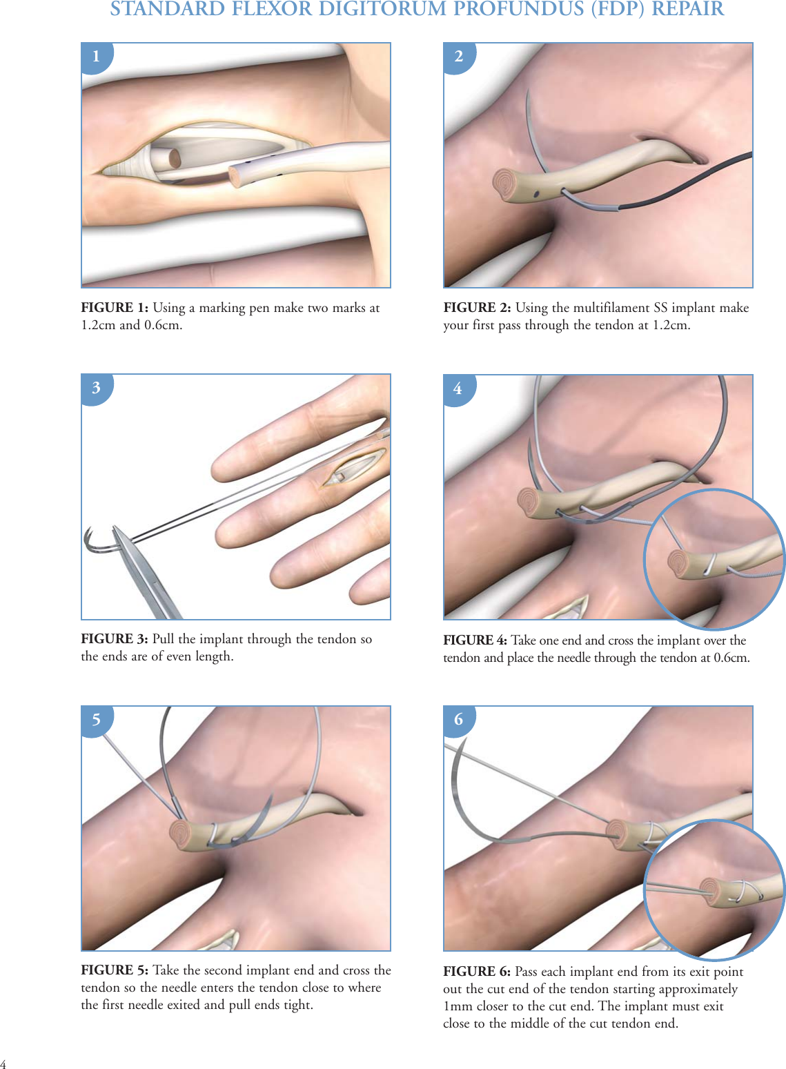 Page 4 of 9 - Print  PONTi S Surgical Technique Brochure 08Oct15
