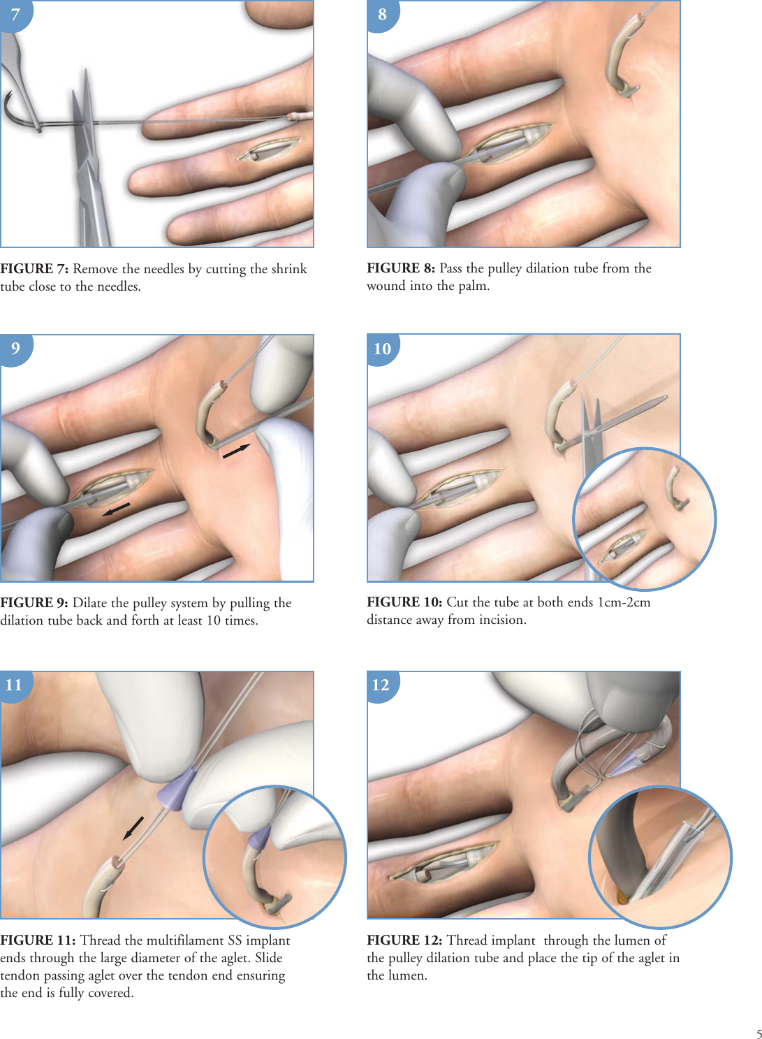 Page 5 of 9 - Print  PONTi S Surgical Technique Brochure 08Oct15