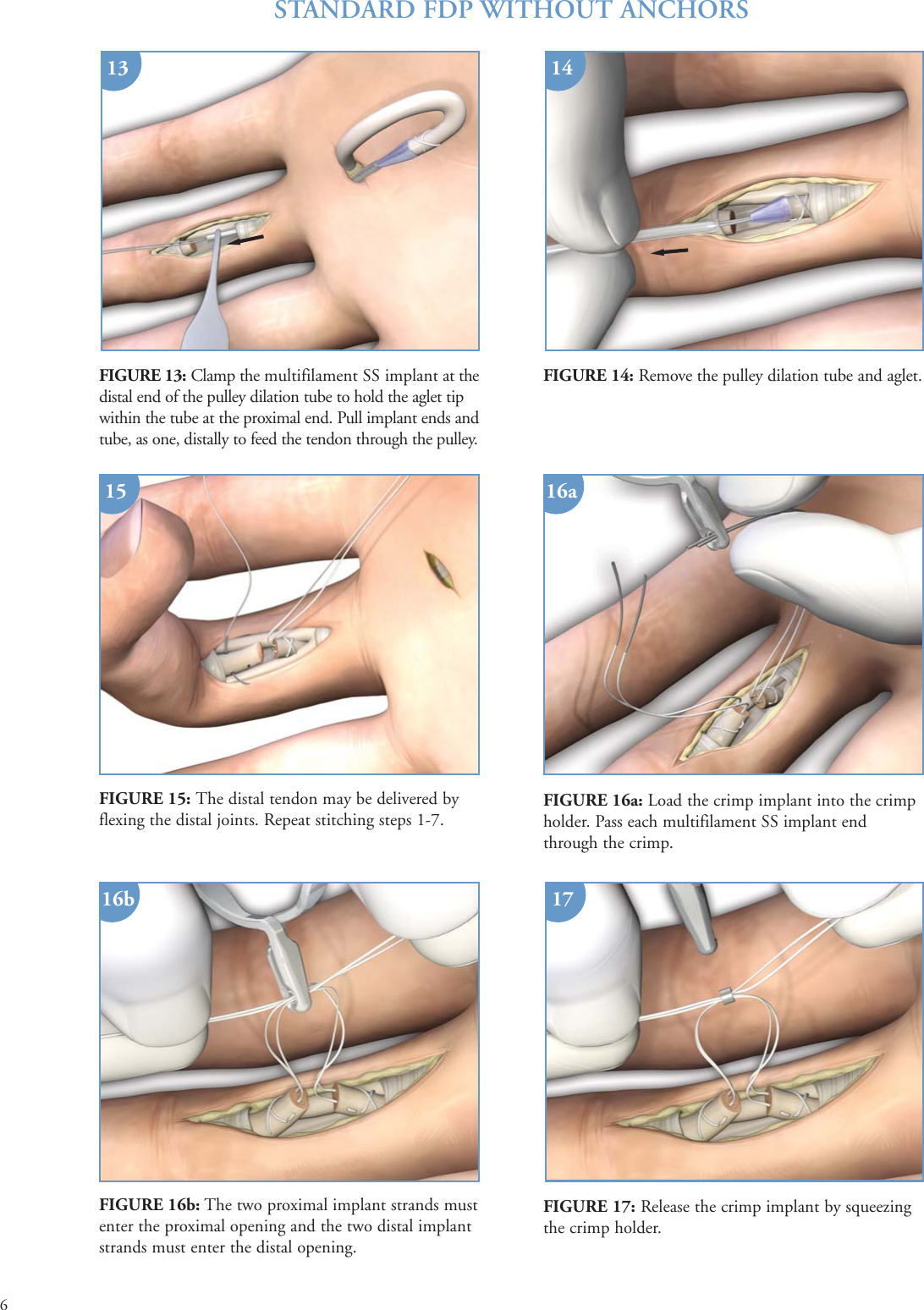 Page 6 of 9 - Print  PONTi S Surgical Technique Brochure 08Oct15