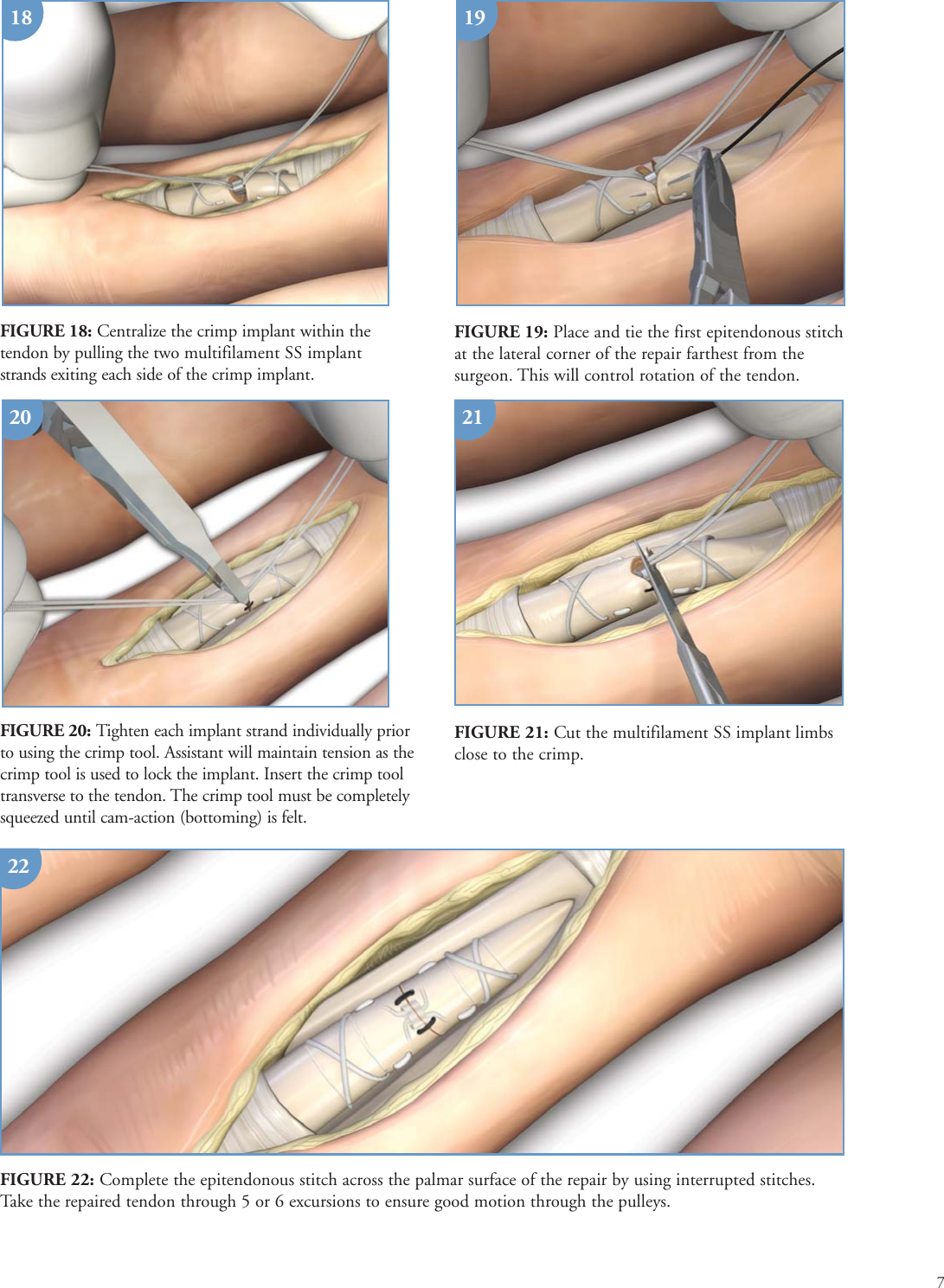 Page 7 of 9 - Print  PONTi S Surgical Technique Brochure 08Oct15