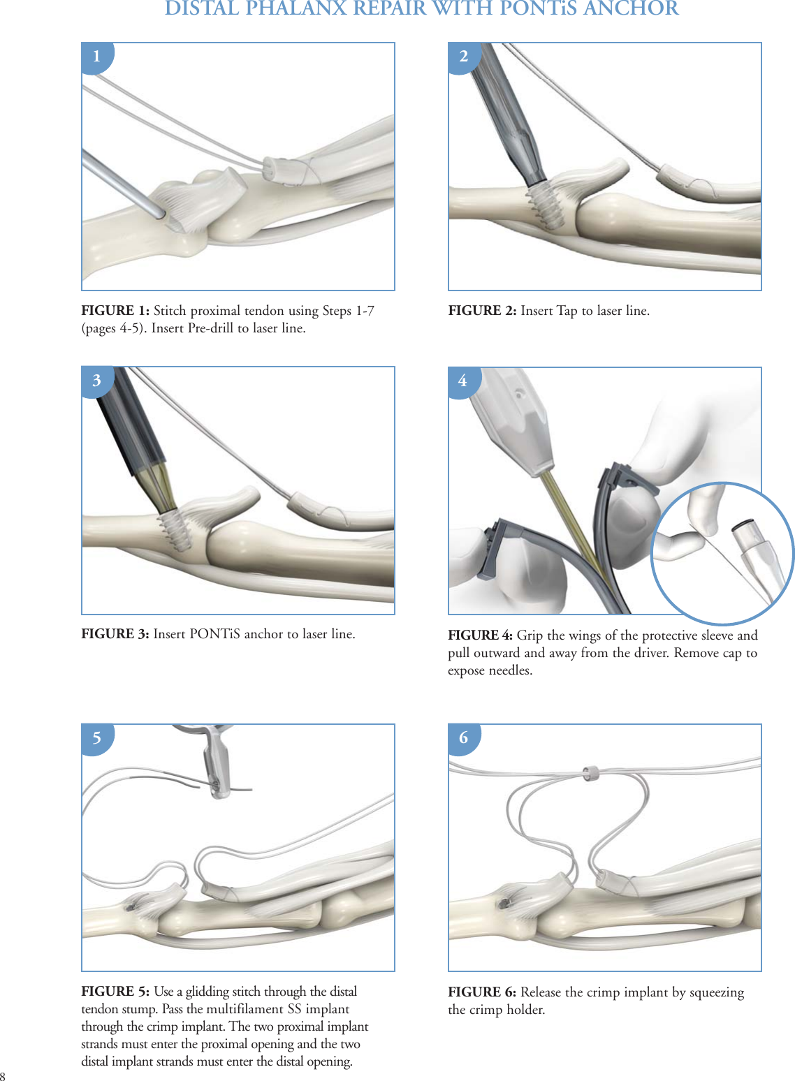 Page 8 of 9 - Print  PONTi S Surgical Technique Brochure 08Oct15