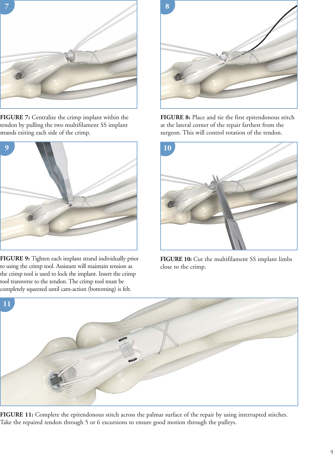 Page 9 of 9 - Print  PONTi S Surgical Technique Brochure 08Oct15