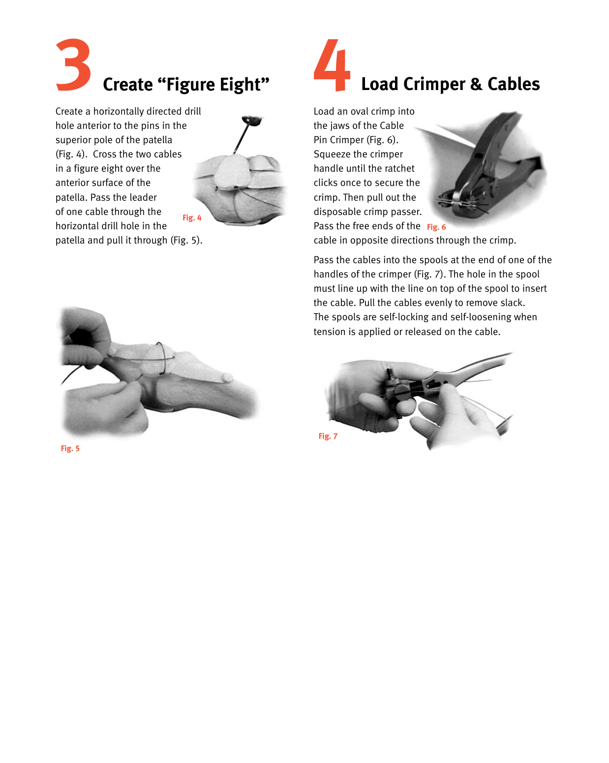 Page 4 of 6 - Zimmer-Cable-Ready-Cable-Pin-System-Abbreviated-Surgical-Technique-Rev2-09-2006