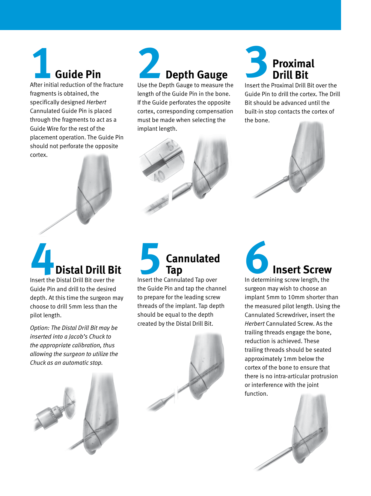 Page 3 of 4 - Zimmer® Herbert™ Cannulated Bone Screw  Zimmer Herbert Surgical Technique