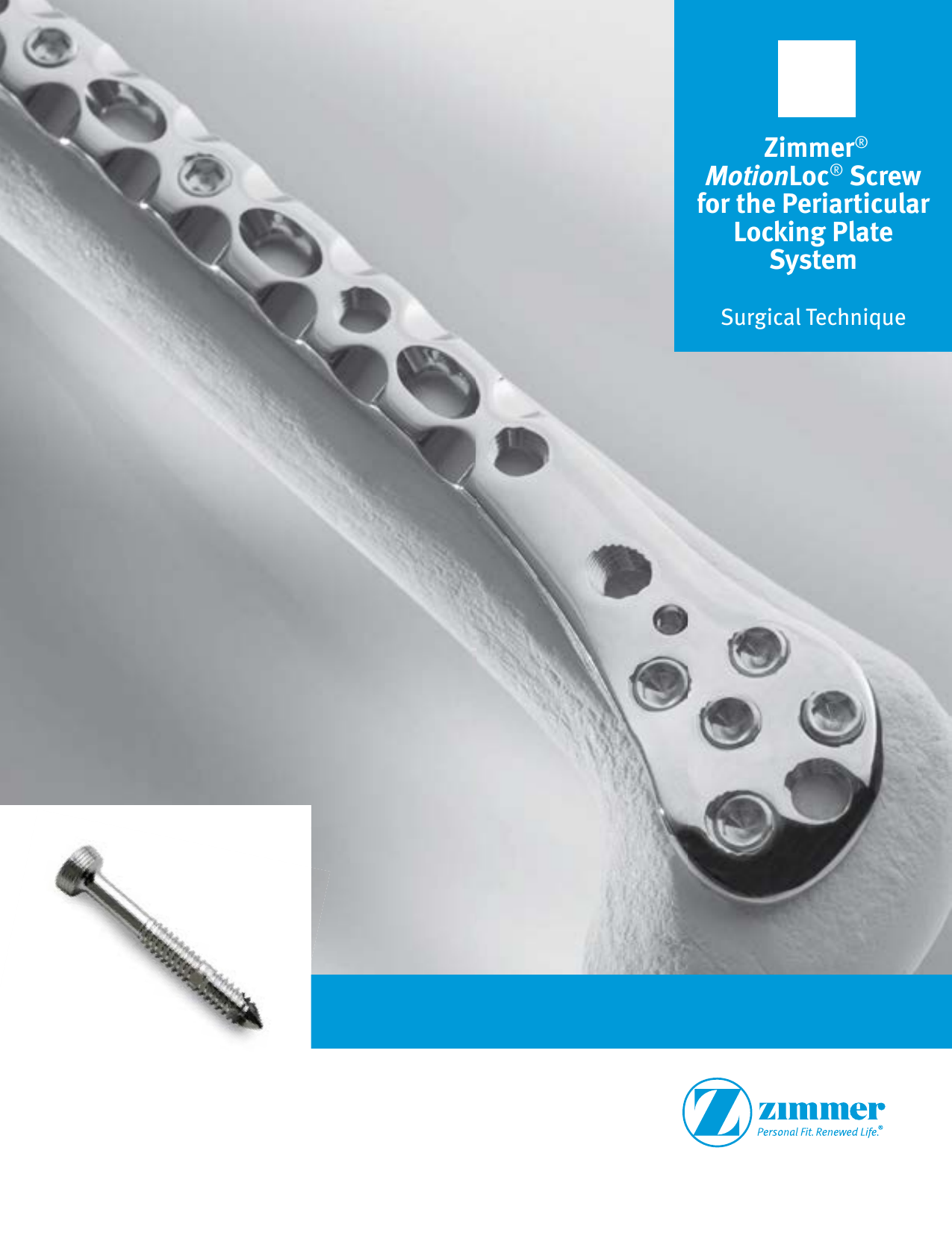 Page 1 of 8 - Zimmer MotionLoc Screw For The Periarticular Locking Plate System Surgical Technique, 97-2347-035-00  Technique