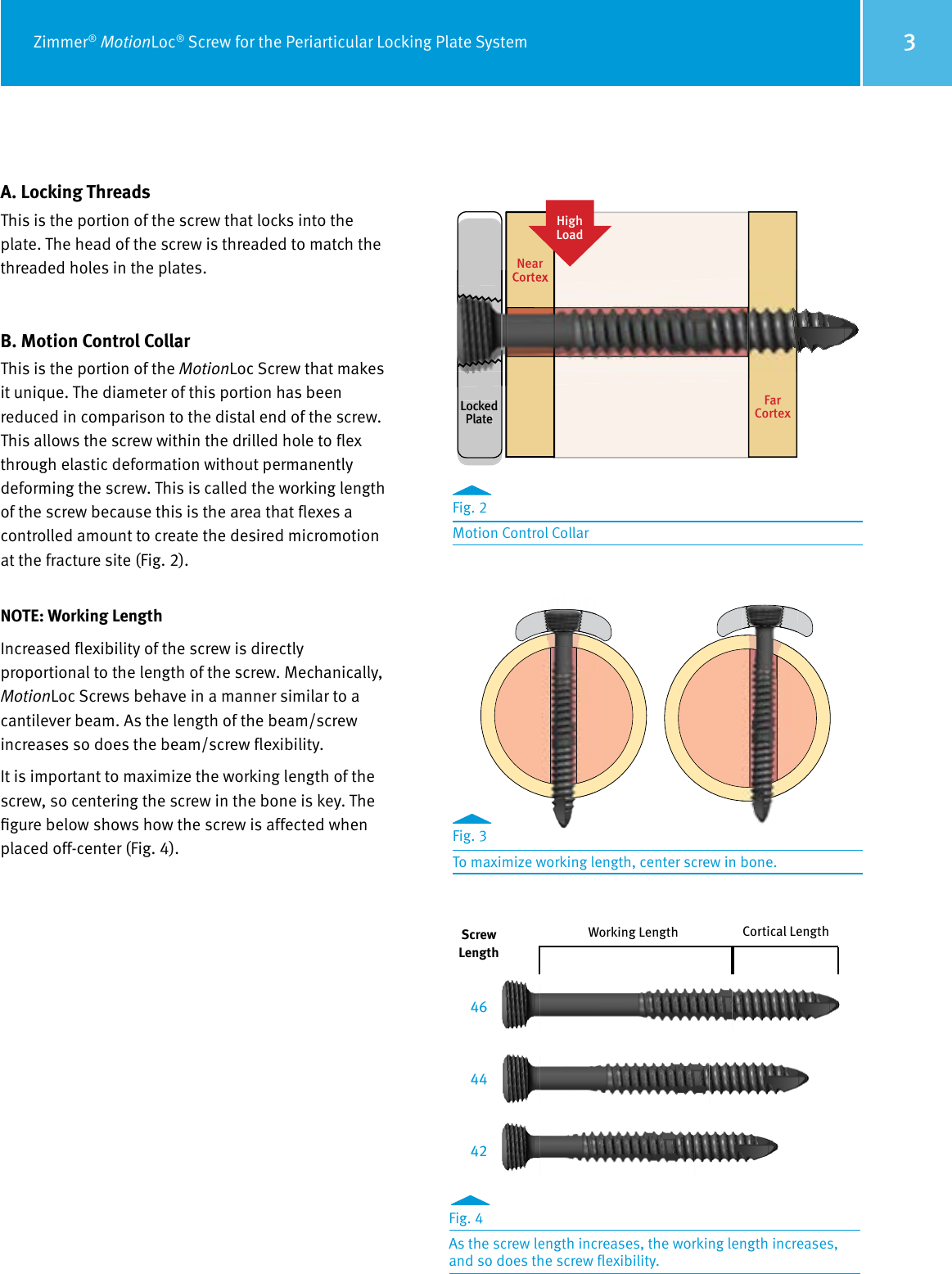 Page 3 of 8 - Zimmer MotionLoc Screw For The Periarticular Locking Plate System Surgical Technique, 97-2347-035-00  Technique