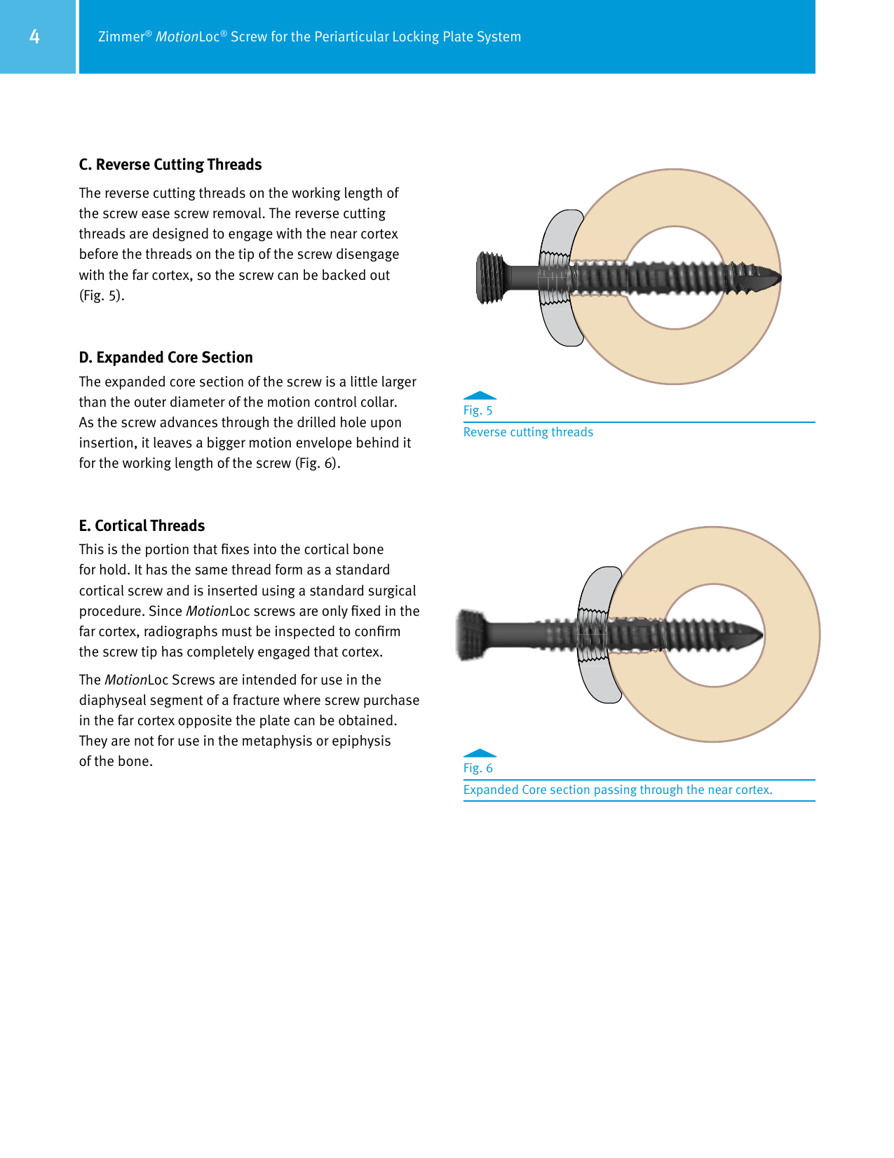 Page 4 of 8 - Zimmer MotionLoc Screw For The Periarticular Locking Plate System Surgical Technique, 97-2347-035-00  Technique