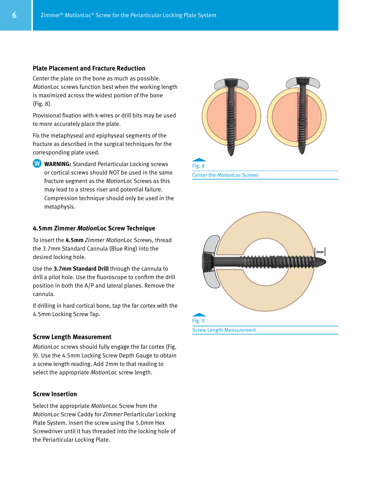 Page 6 of 8 - Zimmer MotionLoc Screw For The Periarticular Locking Plate System Surgical Technique, 97-2347-035-00  Technique